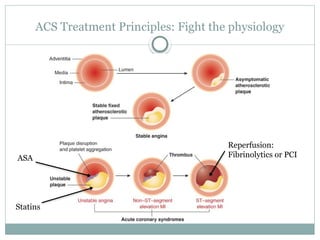 Acute coronary syndrome presentation management | PPTX