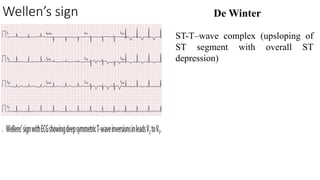 Altered Sign Wave Acute coronary syndrome. myocaridal infraction,heart attack.pptx