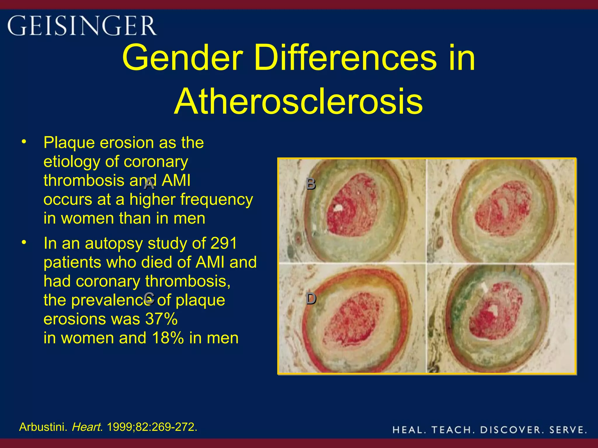 Gender Differences in
                     Atherosclerosis
•   Plaque erosion as the
    etiology of coronary
    thrombosis and AMI
                   A                 B
    occurs at a higher frequency
    in women than in men
•   In an autopsy study of 291
    patients who died of AMI and
    had coronary thrombosis,
                 C
    the prevalence of plaque         D
    erosions was 37%
    in women and 18% in men




Arbustini. Heart. 1999;82:269-272.
 