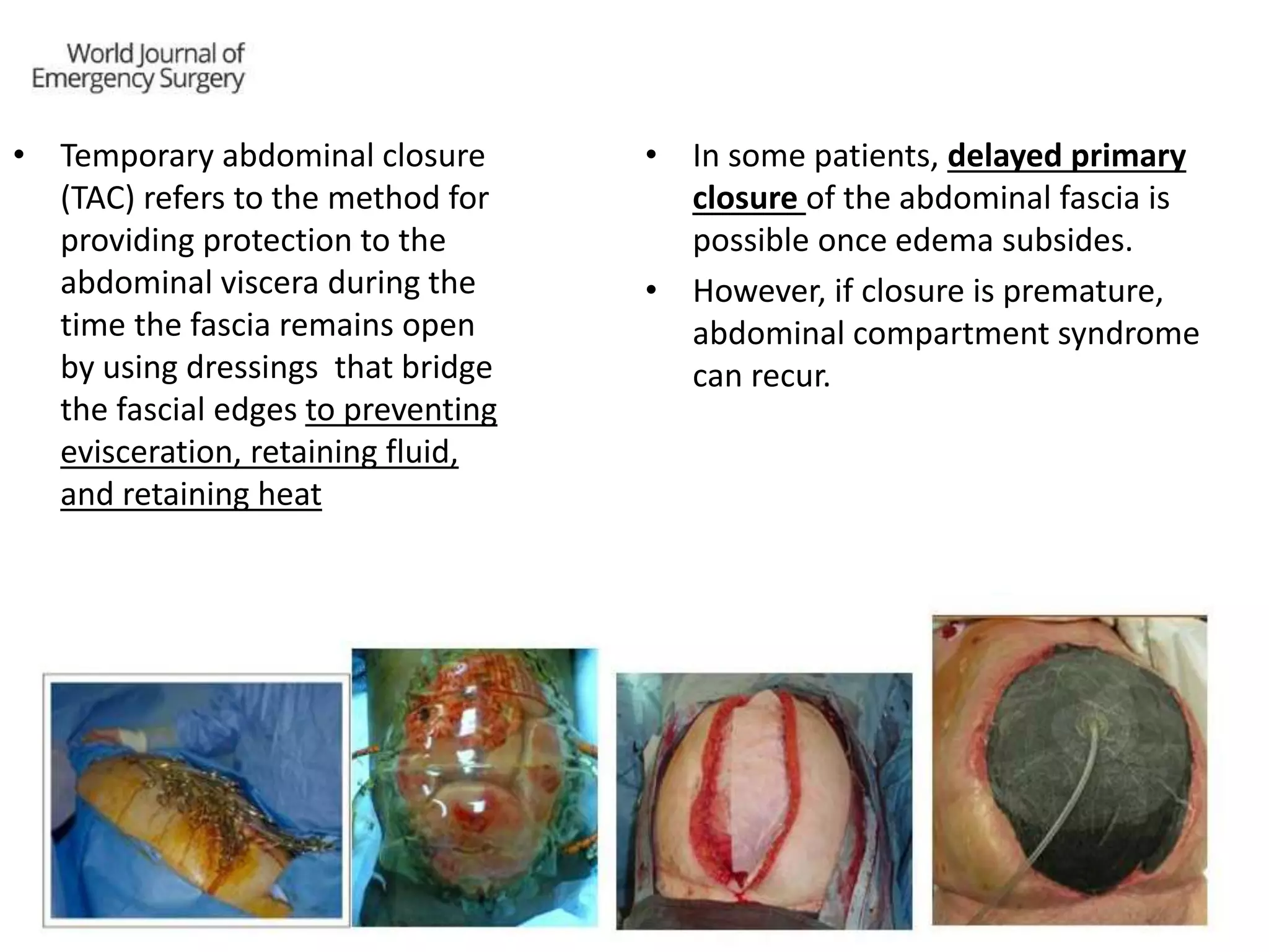 Abdominal Compartment Syndrome | PPTX