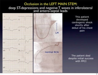 This patient
developed
cardiogenic shock
shortly after
debut of his chest
pain
LM
normal RCA
The patient died
despite initial success
with PPCI
Occlusion in the LEFT MAIN STEM:
deep ST-depressions and negative T waves in inferolateral
and antero-septal leads
12
 