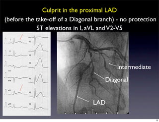 Culprit in the proximal LAD
(before the take-off of a Diagonal branch) - no protection
LAD
Diagonal
Intermediate
ST elevations in I, aVL andV2-V5
13
 