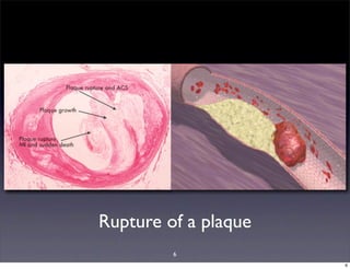 6
Rupture of a plaque
6
 