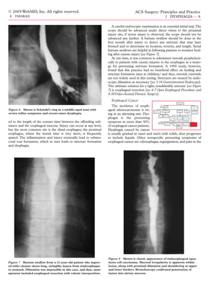 © 2005 WebMD, Inc. All rights reserved.                                                  ACS Surgery: Principles and Practice
4 THORAX                                                                                                       1 DYSPHAGIA — 8

                                                                        A careful endoscopic examination is an essential initial step.The
                                                                     scope should be advanced under direct vision to the proximal
                                                                     injury site; if severe injury is observed, the scope should not be
                                                                     advanced any further. A barium swallow should be done in the
                                                                     ﬁrst month after injury to detect any stricture that may have
                                                                     formed and to determine its location, severity, and length. Serial
                                                                     barium swallows are helpful in following patients to monitor heal-
                                                                     ing after caustic injury [see Figure 7].
                                                                        At one time, it was common to administer steroids prophylacti-
                                                                     cally to patients with caustic injuries to the esophagus as a strate-
                                                                     gy for preventing stricture formation. A 1990 study, however,
                                                                     found that this practice had no beneﬁcial effect on healing and
                                                                     stricture formation rates in children,6 and thus, steroids currently
                                                                     are not widely used in this setting. Strictures are treated by endo-
                                                                     scopic dilatation as necessary [see 5:18 Gastrointestinal Endoscopy].
                                                                     The ultimate solution for a tight, nondilatable stricture [see Figure
                                                                     7] is esophageal resection [see 4:7 Open Esophageal Procedures and
                                                                     4:10 Video-Assisted Thoracic Surgery].
                                                                       Esophageal Cancer
                                                                        The incidence of esoph-
Figure 6 Shown is Schatzki’s ring in a middle-aged man with          ageal adenocarcinoma is ris-
severe reﬂux symptoms and recent-onset dysphagia.                    ing at an alarming rate. Dys-
                                                                     phagia is the presenting
ed to the length of the contact time between the offending sub-      symptom in more than 90%
stance and the esophageal mucosa. Injury can occur at any level,     of esophageal cancer patients.
but the most common site is the distal esophagus; the proximal       Dysphagia caused by cancer
esophagus, where the transit time is very short, is frequently       is usually gradual in onset and starts with solids, then progresses
spared. The inﬂammation and injury eventually lead to submu-         to include liquids. Other nonspeciﬁc presenting symptoms of
cosal scar formation, which in turn leads to stricture formation     esophageal cancer are odynophagia, regurgitation, and pain in the
and dysphagia.




                                                                     Figure 8 Shown is classic appearance of midesophageal squa-
Figure 7 Barium swallow from a 22-year-old patient who ingest-       mous cell carcinoma. Mucosal irregularity is apparent within
ed toilet cleaner shows long, stringlike lumen from midesophagus     lesion, along with proximal dilatation and shouldering at upper
to stomach. Dilatation was impossible in this case, and thus, man-   and lower borders. Bronchoscopy conﬁrmed penetration of
agement included esophageal resection with colonic interposition.    tumor into airway mucosa.
 