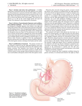 © 2006 WebMD, Inc. All rights reserved.                                                         ACS Surgery: Principles and Practice
4 THORAX                                                                                  7 OPEN ESOPHAGEAL PROCEDURES — 11


   Step 1: incision and entry into peritoneum A midline                        Dissection then proceeds along the greater curvature toward
laparotomy is performed from the tip of the xiphoid to the umbili-          the pylorus. The omentum is mobilized from the right gastroepi-
cus.The peritoneum is opened to the left of the midline so that the         ploic artery.Vessels are ligated between 2-0 silk ties, and great care
falciform and the preperitoneal fat may be retracted en bloc to the         is exercised to avoid placing excessive traction on the arterial
right. Body wall retractors are placed at 45º angles from the mid-          arcade. A 1 cm margin is always maintained between the line of
line to elevate and distract both costal margins.The retractors are         dissection and the right gastroepiploic artery. Venous injuries, in
placed so as to lift up the costal margin gently and open the               particular, can occur with injudicious handling of tissue. The
wound. The abdomen is then inspected for metastases.                        ultrasonic scalpel is particularly efﬁcient and effective for mobi-
                                                                            lization of the stomach; again, this instrument must be applied
   Step 2: division of gastrohepatic ligament and mobiliza-                 well away from the gastroepiploic arcade. Dissection is continued
tion of distal esophagus The left lobe of the liver is mobilized            rightward to the level of the pylorus. It should be noted that the
by dividing the triangular ligament, then folded to the right and           location of the gastroepiploic artery in this area may vary; often, it
held in this position with a moist laparotomy pad and a deep-blad-          is at some unexpected distance from the stomach wall. Posterior
ed self-retaining retractor. Next, the gastrohepatic ligament is divided.   adhesions between the stomach and the pancreas are lysed so that
Occasionally, there is an aberrant left hepatic artery arising from         the lesser sac can be completely opened.
the left gastric artery [see Figure 9].The peritoneum over the right           The assistant’s left hand is then placed into the lesser sac to
crus is incised, and the hiatus is palpated; the extent and mobility        retract the stomach gently to the right and place the short gastric
of any tumor may then be assessed. The peritoneum over the left             vessels on tension. The Penrose drain previously placed around
crus is similarly divided, and the esophagus is encircled with a 2.5 cm     the esophagus facilitates exposure by retracting the cardia to the
Penrose drain. Traction is applied to draw the esophagogastric              right. Dissection along the greater curvature proceeds cephalad.
junction upward and to the right; this measure facilitates exposure         The vessels are divided well away from the wall of the stomach to
of the short gastric arteries coursing to the fundus and the cardia.        prevent injury to the fundus. Clamps should never be placed on
                                                                            the stomach. A high short gastric artery is typically encountered
   Step 3: mobilization of stomach The greater curvature of                 just adjacent to the left crus. Precise technique is required to pre-
the stomach is inspected and the right gastroepiploic artery pal-           vent injury to the spleen. The Penrose drain [see Step 2, above] is
pated.The lesser sac is generally entered near the midpoint of the          exposed as the peritoneum is opened over the left crus.
greater curvature. The transition zone between the right gas-               Mobilization of the proximal stomach and liberation of the distal
troepiploic arcade and the short gastric arteries is usually devoid         esophagus are thereby completed.
of blood vessels. A moist sponge is placed behind the spleen to ele-           Once the stomach has been completely mobilized along the
vate it and facilitate subsequent control of the short gastric vessels.     greater curvature, it is elevated and rotated to the right [see Figure




                                                         Divided Left
                                                         Gastric Vessels


                                                      Lesser Omentum
                                                      Divided




  Figure 9 Transhiatal esophagec-                                                                                        Greater Omentum
  tomy. The duodenum is mobilized,                                                                                       Divided
  and the gastrohepatic and gastro-
  colic omenta are divided.
                                                                                                     Intact Right
                                                                                                     Gastroepiploic
                                                                                                     Vessels
 