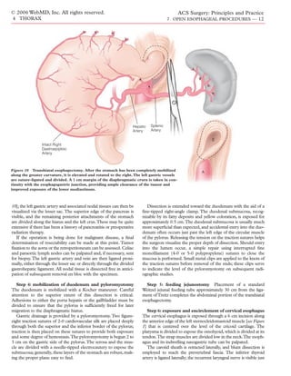 © 2006 WebMD, Inc. All rights reserved.                                                          ACS Surgery: Principles and Practice
4 THORAX                                                                                 7 OPEN ESOPHAGEAL PROCEDURES — 12




                                                                    Hepatic    Splenic
                                                                    Artery     Artery

                                                                                                                    E
                 Intact Right
                 Gastroepiploic
                 Artery



Figure 10 Transhiatal esophagectomy. After the stomach has been completely mobilized                         A
along the greater curvature, it is elevated and rotated to the right. The left gastric vessels
are suture-ligated and divided. A 1 cm margin of the diaphragmatic crura is taken in con-
tinuity with the esophagogastric junction, providing ample clearance of the tumor and
improved exposure of the lower mediastinum.



10]; the left gastric artery and associated nodal tissues can then be        Dissection is extended toward the duodenum with the aid of a
visualized via the lesser sac. The superior edge of the pancreas is       ﬁne-tipped right-angle clamp. The duodenal submucosa, recog-
visible, and the remaining posterior attachments of the stomach           nizable by its fatty deposits and yellow coloration, is exposed for
are divided along the hiatus and the left crus.These may be quite         approximately 0.5 cm. The duodenal submucosa is usually much
extensive if there has been a history of pancreatitis or preoperative     more superﬁcial than expected, and accidental entry into the duo-
radiation therapy.                                                        denum often occurs just past the left edge of the circular muscle
   If the operation is being done for malignant disease, a ﬁnal           of the pylorus. Releasing the tension on the traction sutures helps
determination of resectability can be made at this point. Tumor           the surgeon visualize the proper depth of dissection. Should entry
fixation to the aorta or the retroperitoneum can be assessed. Celiac      into the lumen occur, a simple repair using interrupted ﬁne
and paraortic lymph nodes can be palpated and, if necessary, sent         monoﬁlament (4-0 or 5-0 polypropylene) sutures to close the
for biopsy. The left gastric artery and vein are then ligated proxi-      mucosa is performed. Small metal clips are applied to the knots of
mally, either through the lesser sac or directly through the divided      the traction sutures before removal of the ends; these clips serve
gastrohepatic ligament. All nodal tissue is dissected free in antici-     to indicate the level of the pyloromyotomy on subsequent radi-
pation of subsequent removal en bloc with the specimen.                   ographic studies.

   Step 4: mobilization of duodenum and pyloromyotomy                       Step 5: feeding jejunostomy Placement of a standard
The duodenum is mobilized with a Kocher maneuver. Careful                 Weitzel jejunal feeding tube approximately 30 cm from the liga-
attention to the superior extent of this dissection is critical.          ment of Treitz completes the abdominal portion of the transhiatal
Adhesions to either the porta hepatis or the gallbladder must be          esophagectomy.
divided to ensure that the pylorus is sufﬁciently freed for later
migration to the diaphragmatic hiatus.                                       Step 6: exposure and encirclement of cervical esophagus
   Gastric drainage is provided by a pyloromyotomy. Two ﬁgure-            The cervical esophagus is exposed through a 6 cm incision along
eight traction sutures of 2-0 cardiovascular silk are placed deeply       the anterior edge of the left sternocleidomastoid muscle [see Figure
through both the superior and the inferior border of the pylorus;         1] that is centered over the level of the cricoid cartilage. The
traction is then placed on these sutures to provide both exposure         platysma is divided to expose the omohyoid, which is divided at its
and some degree of hemostasis.The pyloromyotomy is begun 2 to             tendon.The strap muscles are divided low in the neck.The esoph-
3 cm on the gastric side of the pylorus. The serosa and the mus-          agus and its indwelling nasogastric tube can be palpated.
cle are divided with a needle-tipped electrocautery to expose the            The carotid sheath is retracted laterally, and blunt dissection is
submucosa; generally, these layers of the stomach are robust, mak-        employed to reach the prevertebral fascia. The inferior thyroid
ing the proper plane easy to ﬁnd.                                         artery is ligated laterally; the recurrent laryngeal nerve is visible just
 