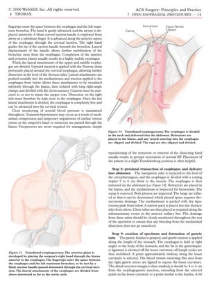 © 2006 WebMD, Inc. All rights reserved.                                                       ACS Surgery: Principles and Practice
4 THORAX                                                                              7 OPEN ESOPHAGEAL PROCEDURES — 14


ﬁngertips enter the space between the esophagus and the left main-                                Pericardium      Vagus Nerves
stem bronchus.The hand is gently advanced, and the airway is dis-                    Carina                        Clipped
placed anteriorly. A blunt curved suction handle is employed from
above as a substitute ﬁnger. It is advanced along the anterior aspect
of the esophagus through the cervical incision. The right hand
guides the tip of the suction handle beneath the bronchus. Lateral
displacement of the handle allows further mobilization of the
bronchus away from the esophagus. Completion of the anterior
and posterior planes usually results in a highly mobile esophagus.
   Third, the lateral attachments of the upper and middle esopha-
gus are divided. Upward traction is applied with the Penrose drain
previously placed around the cervical esophagus, allowing further
dissection at the level of the thoracic inlet. Lateral attachments are
pushed caudally into the mediastinum, and traction applied to the
esophagus from below allows these attachments to be visualized
inferiorly through the hiatus, then isolated with long right-angle
clamps and divided with the electrocautery. Caution must be exer-
cised so as not to injure the azygos vein. Dissection on the right
side must therefore be kept close to the esophagus. Once the last
lateral attachment is divided, the esophagus is completely free and
can be advanced into the cervical wound.
   Close monitoring of arterial blood pressure is maintained
throughout.Transient hypotension may occur as a result of medi-
astinal compression and temporary impairment of cardiac venous
return as the surgeon’s hand or retractors are passed through the
hiatus. Vasopressors are never required for management: simple
                                                                         Figure 14 Transhiatal esophagectomy. The esophagus is divided
                                                                         in the neck and delivered into the abdomen. Retractors are
                                                                         placed in the hiatus, and any vessels entering into the esophagus
                                                                         are clipped and divided. The vagi are also clipped and divided.


                                                                         repositioning of the retractors or removal of the dissecting hand
                                                                         usually results in prompt restoration of normal BP. Placement of
                                                                         the patient in a slight Trendelenburg position is often helpful.

                                                                            Step 8: proximal transection of esophagus and delivery
                                                                         into abdomen The nasogastric tube is retracted to the level of
                                                                         the cricopharyngeus, and the esophagus is divided with a cutting
                                                                         stapler 5 to 6 cm distal to the muscle. The esophagus is then
                                                                         removed via the abdomen [see Figure 14]. Retractors are placed in
                                                                         the hiatus, and the mediastinum is inspected for hemostasis. The
                                                                         sump is removed. Both pleurae are inspected.The lungs are inﬂat-
                                                                         ed so that it can be determined which pleural space requires tho-
                                                                         racostomy drainage. The mediastinum is packed with dry lapa-
                                                                         rotomy pads from below. A narrow pack is placed into the thoracic
                                                                         inlet from above. Chest tubes are then placed as required along the
                                                                         inframammary crease in the anterior axillary line. The drainage
                                                                         from these tubes should be closely monitored throughout the rest
                                                                         of the operation to ensure that any bleeding from the mediastinal
                                                                         dissection does not go unnoticed.

                                                                            Step 9: excision of specimen and formation of gastric
                                                                         tube The gastric fundus is grasped, and gentle tension is applied
                                                                         along the length of the stomach. The esophagus is held at right
                                                                         angles to the body of the stomach, and the fat in the gastrohepat-
                                                                         ic ligament is elevated off the lesser curvature; all lymph nodes are
Figure 13 Transhiatal esophagectomy. The anterior plane is
                                                                         thus mobilized. A point approximately midway along the lesser
developed by placing the surgeon’s right hand through the hiatus
anterior to the esophagus. The ﬁngertips enter the space between
                                                                         curvature is selected. The blood vessels traversing this area from
the esophagus and the left mainstem bronchus, to be met by a             the right gastric artery are ligated to expose the lesser curvature.
blunt suction handle passed downward through the cervical inci-          The distal resection margin is then marked; it should be 4 to 6 cm
sion. The lateral attachments of the esophagus are divided from          from the esophagogastric junction, extending from the selected
above downward as far as the aortic arch.                                point on the lesser curvature to a point medial to the fundus. A 60
 