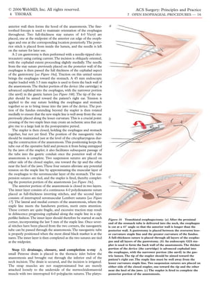 © 2006 WebMD, Inc. All rights reserved.                                                     ACS Surgery: Principles and Practice
4 THORAX                                                                              7 OPEN ESOPHAGEAL PROCEDURES — 16


anterior wall then forms the hood of the anastomosis. The ﬁne-           a
toothed forceps is used to maintain orientation of the esophagus
throughout. Two full-thickness stay sutures of 4-0 Vicryl are
placed, one at the midpoint of the anterior cut edge of the esoph-
agus and one at the corresponding location posteriorly.The poste-
rior stitch is placed from inside the lumen, and the needle is left
on the suture for later use.
   A 2 cm gastrotomy is then performed with a needle-tipped elec-
trocautery using cutting current.The incision is obliquely oriented,
with the cephalad extent proceeding slightly medially. The needle
from the stay suture previously placed on the posterior wall of the
esophagus is then passed the full thickness of the cephalad aspect
of the gastrotomy [see Figure 16a]. Traction on this untied suture
brings the esophagus toward the stomach. A 45 mm endoscopic
stapler loaded with 3.5 mm staples is used to form the back wall of
the anastomosis.The thicker portion of the device (the cartridge) is
advanced cephalad into the esophagus, with the narrower portion
(the anvil) in the gastric lumen [see Figure 16b]. The tip of the sta-
pler should be aimed toward the patient’s right ear. Tension is
applied to the stay suture holding the esophagus and stomach
together so as to bring tissue into the jaws of the device. The por-
tion of the fundus extending beyond the stapler is then rotated
medially to ensure that the new staple line is well away from the one
previously placed along the lesser curvature.This is a crucial point:    b
crossing of the two staple lines may create an ischemic area that can
give rise to a large leak in the postoperative period.
   The stapler is then closed, holding the esophagus and stomach
together, but not yet ﬁred. The position of the nasogastric tube
should be maintained just at the level of the cricopharyngeus dur-
ing the construction of the anastomosis.This positioning keeps the
tube out of the operative ﬁeld and protects it from being entrapped
by the jaws of the stapler; it also facilitates subsequent passage of
the tube into the gastric conduit once the posterior wall of the
anastomosis is complete. Two suspension sutures are placed on
either side of the closed stapler, one toward the tip and the other
near the heel of the jaws.These four sutures alleviate any potential
tension on the staple line by approximating the muscular layer of
the esophagus to the seromuscular layer of the stomach. The sus-
pension sutures are tied, and the stapler is ﬁred, thereby complet-      c
ing the posterior portion of the anastomosis [see Figure 16c].
   The anterior portion of the anastomosis is closed in two layers.
The inner layer consists of a continuous 4-0 polydioxanone suture
placed as full-thickness inverting stitches, and the second layer
consists of interrupted seromuscular Lembert sutures [see Figure
17]. The lateral and medial corners of the anastomosis, where the
staple line meets the handsewn portion, merit extra attention.
These corners are quite fragile, and excessive traction may result
in dehiscence progressing cephalad along the staple line in a zip-
perlike fashion.The inner layer should therefore be started at each      Figure 16 Transhiatal esophagectomy. (a) After the proximal
corner, incorporating the last 5 mm of the staple line. Once sever-      end of the stomach tube is delivered into the neck, the esophagus
al stitches have been placed from the two corners, the nasogastric       is cut at a 45° angle so that the anterior wall is longer than the
tube can be passed through the anastomosis.The nasogastric tube          posterior wall. A gastrotomy is placed between the oversewn less-
is properly positioned when the most distal black marker is at the       er curvature staple line and the greater curvature of the fundus.
nares.The inner layer is then completed as the two sutures are tied      A full-thickness suture is placed through all layers of the esopha-
at the midpoint.                                                         gus and all layers of the gastrotomy. (b) An endoscopic GIA sta-
                                                                         pler is used to form the back wall of the anastomosis. The thicker
   Step 12: drainage, closure, and completion x-ray A                    portion of the device (the cartridge) is advanced cephalad into
                                                                         the esophagus, with the narrower portion (the anvil) in the gas-
small Penrose drain is placed in the thoracic inlet below the
                                                                         tric lumen. The tip of the stapler should be aimed toward the
anastomosis and brought out through the inferior end of the              patient’s right ear. The staple line must be well away from the
neck incision. The drain is secured, and the incision is irrigated.      lesser curvature staple line. Two suspension sutures are placed on
The strap muscles are not reapproximated but are merely                  either side of the closed stapler, one toward the tip and the other
attached loosely to the underside of the sternocleidomastoid             near the heel of the jaws. (c) The stapler is ﬁred to complete the
muscle with two interrupted 4-0 polyglactin sutures. The platys-         posterior portion of the anastomosis.
 