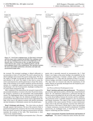 © 2006 WebMD, Inc. All rights reserved.                                                             ACS Surgery: Principles and Practice
4 THORAX                                                                                     7 OPEN ESOPHAGEAL PROCEDURES — 18



 a                                                                          b
 Azygos Vein                                                                 Left Recurrent                             Right Recurrent Laryngeal
                                                          Diaphragm
 Ligated and                                                                 Laryngeal                                  Nerve and Nodes
 Divided                                                                     Nerve and Nodes
                                    Retracted
                                    Right Lung


                                                                                                                                        Thoracic
                                                                                                                                        Duct
                                                                                Left Vagus
                                                                                Nerve



                                      Aorta
                                                                          Azygos Vein
                                                                          (Ligated)




                                                                                                                                      Subcarinal
                                                                                                                                      and Hilar
                                                                                                      Pericardium                     Nodes

  Figure 18 Ivor-Lewis esophagectomy. (a) The lung is retracted,
  and the azygos vein is stapled and divided. The esophagus and
  the vagi are mobilized from the level of the diaphragm to the
  thoracic inlet. (b) Dissection en bloc via right thoracotomy
  of the thoracic duct, azygos vein, ipsilateral pleura, and all
  periesophageal tissue in the mediastinum. The specimen includes                                             Thoracic Duct      Periesophageal
  the lower and middle mediastinal, subcarinal, and right-side                          Left Lung             (Ligated)          Nodes
  paratracheal lymph nodes.



the stomach. The proximal esophagus is dilated sufﬁciently to                gastric tube is generally removed on postoperative day 3. Oral
accommodate at least a 25 mm head. The anvil is placed into the              intake is not begun at this point; feeding is accomplished via the
distal esophagus and secured with a purse-string suture.The tip of           temporary jejunostomy. A barium contrast study is performed
the stapler is brought out through the apical wall of the stomach            approximately 5 to 7 days after the operation. If there is no anas-
and attached to the anvil. The stapler is then ﬁred to create the            tomotic leakage, oral intake is initiated and advanced as tolerated.
end-to-end anastomosis, and the gastrotomy is closed.The advan-              The chest tubes are removed only after the reinstitution of oral
tages of this technique are its relative simplicity and the theoretical      intake. Patients are generally discharged from the hospital by post-
security of a completely stapled anastomosis; the main potential             operative day 8 to 10.
disadvantage is the risk of postoperative dysphagia resulting from
an overly narrow anastomotic ring.                                               Left Thoracoabdominal Esophagogastrectomy
   After completion of the anastomosis, the stomach is inspected for            Step 1: incision and entry into peritoneum The patient is
any potential redundancy or torsion in the chest.To prevent torsion,         placed in the right lateral position, with the hips rotated backward
the stomach is anchored to the pericardium with nonabsorbable                about 30°. An exploratory laparotomy is performed through an
sutures.The diaphragmatic hiatus is then inspected: it should allow          oblique incision extending from the tip of the sixth costal cartilage
easy passage of two ﬁngers into the abdomen alongside the trans-             to a point about halfway between the sternum and the umbilicus.
posed stomach. Interrupted sutures may be used to approximate the            The peritoneal cavity is carefully examined to rule out peritoneal
edge of the crura to the adjacent stomach wall, thereby preventing           and hepatic metastases. The region of the cardia is palpated and
any later herniation of abdominal contents into the pleural space.           the mobility of the tumor assessed. If there is minor involvement
                                                                             of the crura or the tail of the pancreas, resection may still be pos-
   Step 9: drainage and closure Two chest tubes are placed                   sible; however, if the tumor is ﬁrmly ﬁxed or there are peritoneal
through separate stab incisions. The tip of the posterior drain is           or hepatic metastases, resection should be abandoned. A feeding
positioned alongside the stomach at the level of the anastomosis.            jejunostomy, an esophageal stent, or both may be inserted to
Fine gut sutures secured to the adjacent parietal pleura will help           improve swallowing and allow nutrition.
maintain the position of the tube. The thoracotomy is then
closed in the standard fashion.                                                Step 2: assessment of gastric involvement and incision of
   Patients should begin walking on postoperative day 1.The naso-            diaphragm The extent to which the tumor involves the stom-
 