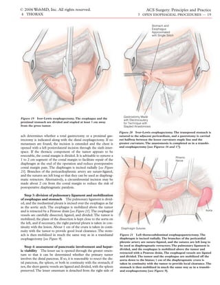 © 2006 WebMD, Inc. All rights reserved.                                                         ACS Surgery: Principles and Practice
4 THORAX                                                                                7 OPEN ESOPHAGEAL PROCEDURES — 19


                                                                                                    Stomach and
                                                                                                    Esophagus
                                                                                                    Approximated
                                                                                                    with Single Stitch




                                                                              Gastrostomy Made
Figure 19 Ivor-Lewis esophagectomy. The esophagus and the
                                                                              with Electrocautery
proximal stomach are divided and stapled at least 5 cm away                   for Technique with
from the gross tumor.                                                         Stapled Anastomosis

                                                                           Figure 20 Ivor-Lewis esophagectomy. The transposed stomach is
ach determines whether a total gastrectomy or a proximal gas-              sutured to the adjacent pericardium, and a gastrotomy is carried
trectomy is indicated along with the distal esophagectomy. If no           out halfway between the lesser curvature staple line and the
metastases are found, the incision is extended and the chest is            greater curvature. The anastomosis is completed as in a transhi-
opened with a left posterolateral incision through the sixth inter-        atal esophagectomy [see Figures 16 and 17].
space. If the thoracic component of the tumor appears to be
resectable, the costal margin is divided. It is advisable to remove a
                                                                                                                         Phrenic
1 to 2 cm segment of the costal margin to facilitate repair of the                                                       Nerve
diaphragm at the end of the operation and reduce postoperative
costal margin pain. The diaphragm is incised radially [see Figure
21]. Branches of the pericardiophrenic artery are suture-ligated,
and the sutures are left long so that they can be used as diaphrag-
matic retractors. Alternatively, a circumferential incision may be
made about 2 cm from the costal margin to reduce the risk of
postoperative diaphragmatic paralysis.

   Step 3: division of pulmonary ligament and mobilization
of esophagus and stomach The pulmonary ligament is divid-
ed, and the mediastinal pleura is incised over the esophagus as far
as the aortic arch. The esophagus is mobilized above the tumor
and is retracted by a Penrose drain [see Figure 21].The esophageal                                                                       Aorta
vessels are carefully dissected, ligated, and divided. The tumor is
mobilized; the plane of the dissection is kept close to the aorta on
the left, and if necessary, the right parietal pleura is taken in con-
tinuity with the lesion. About 1 cm of the crura is taken in conti-         Diaphragm Sutures
nuity with the tumor to provide good local clearance. The stom-
ach is then mobilized in much the same way as in a transhiatal             Figure 21 Left thoracoabdominal esophagogastrectomy. The
esophagectomy [see Figure 9].                                              diaphragm is incised radially. The branches of the pericardial
                                                                           phrenic artery are suture-ligated, and the sutures are left long to
   Step 4: assessment of pancreatic involvement and hepat-                 be used as diaphragmatic retractors. The pulmonary ligament is
                                                                           divided, and the esophagus is mobilized above the tumor and
ic viability The lesser sac is opened through the greater omen-
                                                                           retracted with a Penrose drain. The esophageal vessels are ligated
tum so that it can be determined whether the primary tumor                 and divided. The tumor and the esophagus are mobilized off the
involves the distal pancreas. If so, it is reasonable to resect the dis-   aorta down to the hiatus; 1 cm of the diaphragmatic crura is
tal pancreas, the spleen, or both in continuity with the stomach; if       taken in continuity with the tumor to provide local clearance. The
not, the short gastric vessels are ligated and divided, with the spleen    stomach is then mobilized in much the same way as in a transhi-
preserved. The lesser omentum is detached from the right side of           atal esophagectomy [see Figure 9].
 