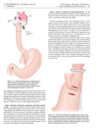 © 2006 WebMD, Inc. All rights reserved.                                                      ACS Surgery: Principles and Practice
4 THORAX                                                                               7 OPEN ESOPHAGEAL PROCEDURES — 20


                                                                            Step 6: choice of partial or total gastrectomy At this
                                                                         time, the surgeon determines whether the whole stomach must be
                                         Aorta                           resected to remove the gastric part of the cancer or whether a par-
                                                                         tial (i.e., proximal) gastrectomy will sufﬁce.
      Azygos
      Vein
                                                                            Proximal esophagogastrectomy with esophagogastrostomy. If the
                                                                         surgeon decides that resection of the proximal stomach will re-
                                                                         move all of the tumor while leaving at least 5 cm of tumor-free
                                                                         stomach, a proximal esophagogastrectomy is performed [see Figure
                                                                         22]. A gastric tube is fashioned with a linear stapler [seeTranshiatal
                                                                         Esophagectomy, Step 9, above, and Figure 15]. The staple line is
                                      Inferior                           oversewn with inverting 3-0 sutures. Because the vagus nerves are
                                      Pulmonary
                                      Vein
                                                                         divided and gastric stasis may result, a pyloromyotomy is per-
                                                                         formed, much as in a transhiatal esophagectomy.
                                                                            The proximal gastric resection margin is covered with a sponge
                                                                         and turned upward over the costal margin. The stomach tube is
                                                                         then brought up through the hiatus and into the thorax behind the
                                                                         proximal esophageal resection margin. The margin should be at
                                                                         least 10 cm from the proximal end of the esophagogastric cancer.
                                                                         If the esophageal resection margin is not adequate, the stomach
                                                                         tube is mobilized and brought to the left neck, then anastomosed
                                                                         to the cervical esophagus through a left neck incision; alternative-
                                                                         ly, the left colon is interposed between the gastric stump and the
                                                                         cervical esophagus. If the resection margin is adequate, the tip of
                                                                         the stomach tube is sewn to the posterior wall of the esophagus
                                                                         [see Figure 23].




      Figure 22 Left thoracoabdominal esophagogastrec-
      tomy: proximal esophagogastrectomy with esopha-
      gogastrostomy. If the tumor can be completely
      resected by removing the proximal stomach, a prox-
      imal esophagogastrectomy is carried out.

the esophagus and the hilum of the liver, then divided down to the
area of the pylorus, with the right gastric artery and vein preserved.
There is often a hepatic branch from the left gastric artery running
through the gastrohepatic omentum. If this hepatic branch is of sig-
niﬁcant size, a soft vascular clamp should be placed on the artery
for 20 minutes so that the viability of the liver can be assessed. If
the liver is viable, the artery is suture-ligated and divided.

   Step 5: division of greater omentum and short gastric
vessels The greater omentum is divided, with care taken to pre-
serve the right gastroepiploic artery and vein.These two vessels are
suture-ligated and divided well away from the stomach. Ligation
and division of the short gastric vessels allow complete mobiliza-
tion of the greater curvature of the stomach. Dissection is extend-      Figure 23 Left thoracoabdominal esophagogastrectomy: proxi-
ed downward as far as the pylorus.The stomach is turned upward,          mal esophagogastrectomy with esophagogastrostomy. The esoph-
and the left gastric vessels are exposed through the lesser sac [see     agus is sewn to the tip of the stomach tube, halfway between the
Figure 10].The lymph nodes along the celiac axis and the left gas-       lesser curvature suture line and the greater curvature. An anasto-
tric artery are swept up into the specimen, and the gastric vessels      mosis is then fashioned with the stapling technique used in trans-
are either suture-ligated or stapled and divided.                        hiatal esophagectomy [see Figures 16 and 17].
 