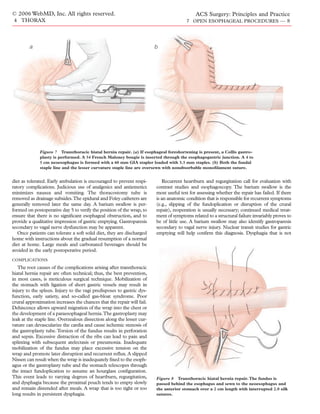 © 2006 WebMD, Inc. All rights reserved.                                                     ACS Surgery: Principles and Practice
4 THORAX                                                                               7 OPEN ESOPHAGEAL PROCEDURES — 8




        a                                                               b




              Figure 7 Transthoracic hiatal hernia repair. (a) If esophageal foreshortening is present, a Collis gastro-
              plasty is performed. A 54 French Maloney bougie is inserted through the esophagogastric junction. A 4 to
              5 cm neoesophagus is formed with a 60 mm GIA stapler loaded with 3.5 mm staples. (b) Both the fundal
              staple line and the lesser curvature staple line are oversewn with nonabsorbable monoﬁlament suture.


diet as tolerated. Early ambulation is encouraged to prevent respi-        Recurrent heartburn and regurgitation call for evaluation with
ratory complications. Judicious use of analgesics and antiemetics       contrast studies and esophagoscopy. The barium swallow is the
minimizes nausea and vomiting. The thoracostomy tube is                 most useful test for assessing whether the repair has failed. If there
removed as drainage subsides.The epidural and Foley catheters are       is an anatomic condition that is responsible for recurrent symptoms
generally removed later the same day. A barium swallow is per-          (e.g., slipping of the fundoplication or disruption of the crural
formed on postoperative day 5 to verify the position of the wrap, to    repair), reoperation is usually necessary; continued medical treat-
ensure that there is no signiﬁcant esophageal obstruction, and to       ment of symptoms related to a structural failure invariably proves to
provide a qualitative impression of gastric emptying. Gastroparesis     be of little use. A barium swallow may also identify gastroparesis
secondary to vagal nerve dysfunction may be apparent.                   secondary to vagal nerve injury. Nuclear transit studies for gastric
   Once patients can tolerate a soft solid diet, they are discharged    emptying will help conﬁrm this diagnosis. Dysphagia that is not
home with instructions about the gradual resumption of a normal
diet at home. Large meals and carbonated beverages should be
avoided in the early postoperative period.
COMPLICATIONS

   The root causes of the complications arising after transthoracic
hiatal hernia repair are often technical; thus, the best prevention,
in most cases, is meticulous surgical technique. Mobilization of
the stomach with ligation of short gastric vessels may result in
injury to the spleen. Injury to the vagi predisposes to gastric dys-
function, early satiety, and so-called gas-bloat syndrome. Poor
crural approximation increases the chances that the repair will fail.
Dehiscence allows upward migration of the wrap into the chest or
the development of a paraesophageal hernia.The gastroplasty may
leak at the staple line. Overzealous dissection along the lesser cur-
vature can devascularize the cardia and cause ischemic stenosis of
the gastroplasty tube. Torsion of the fundus results in perforation
and sepsis. Excessive distraction of the ribs can lead to pain and
splinting with subsequent atelectasis or pneumonia. Inadequate
mobilization of the fundus may place excessive tension on the
wrap and promote later disruption and recurrent reﬂux. A slipped
Nissen can result when the wrap is inadequately ﬁxed to the esoph-
agus or the gastroplasty tube and the stomach telescopes through
the intact fundoplication to assume an hourglass conﬁguration.
This event leads to varying degrees of heartburn, regurgitation,        Figure 8 Transthoracic hiatal hernia repair. The fundus is
and dysphagia because the proximal pouch tends to empty slowly          passed behind the esophagus and sewn to the neoesophagus and
and remain distended after meals. A wrap that is too tight or too       the anterior stomach over a 2 cm length with interrupted 2.0 silk
long results in persistent dysphagia.                                   sutures.
 