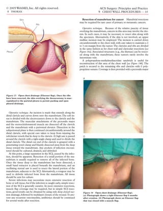 © 2005 WebMD, Inc. All rights reserved.                                                       ACS Surgery: Principles and Practice
 4 THORAX                                                                                    9 CHEST WALL PROCEDURES — 10

              Skin                                                          Resection of manubrium for cancer Manubrial resections
                                                                           may be required for rare cases of primary or metastatic cancers.
                               Rib
                                                                              Operative technique. Because of the relative paucity of tissue
                                                                           overlying the manubrium, cancers in this area may involve the der-
                                                                           mis. In such cases, it may be necessary to resect skin along with
                                                                           the specimen. Alternatively, if the skin is not involved, an upper
                                                                           midline incision may be employed. The incision is carried down
                                                                           circumferentially to the chest wall, with care taken to maintain a 2
                                                                           to 3 cm margin from the tumor.The clavicles and ribs are divided
                                                                           in the same fashion as for chest wall and clavicular resections [see
Pleura                                                                     Figure 14a]. Associated structures (e.g., the thymus) can be resect-
                                                                           ed along with the manubrium; these tumors rarely involve the
                                                                           innominate vein.
                                                                              A polypropylene-methylmethacrylate sandwich is useful for
                                                                           reconstruction of this area of the chest wall [see Figure 14b]. The
                                                                           patch is secured to the remaining ribs and clavicles with 0 poly-
                                                                           propylene sutures. Coverage is then provided with a pectoralis major


                                                                              a




Figure 15 Open chest drainage (Eloesser ﬂap). Once the ribs
have been resected, the skin overlying the thoracostomy is mar-
supialized to the parietal pleura to permit packing and open
pleural drainage.



   Operative technique. An incision is made that extends along the
distal clavicle and curves down onto the manubrium.The soft tis-
sue is divided with the electrocautery down to the clavicle and the
manubrium. The muscular attachments of the pectoralis major
and the sternocleidomastoid muscle are dissected off the clavicle
and the manubrium with a periosteal elevator. Dissection in the
subperiosteal plane is then continued circumferentially around the
distal clavicle, with special care taken to keep from injuring the
subclavian vessels that lie deep to the clavicle. A Gigli saw is passed       b
around the clavicle with a right-angle clamp and used to divide the
distal clavicle. The distal cut end of the clavicle is grasped with a
penetrating towel clamp and bluntly dissected away from the deep
tissue toward the manubrium. Any pockets of infection encoun-
tered should be cultured, drained, and debrided.
   At this point, a large separation in the SCJ, caused by the infec-
tion, should be apparent. Resection of a small portion of the ma-
nubrium is usually required to remove all of the infected bone.
Once the tissue deep to the manubrium has been dissected, a
small band retractor is placed beneath the manubrium, and an
oscillating sternal saw is used to resect the lateral portion of the
manubrium, adjacent to the SCJ. Alternatively, a rongeur may be
used to debride infected bone from the manubrium. All tissue
should be sent for culture.
   Severe infections may necessitate more extensive resection of
bone or soft tissue, but if the infection is caught early, simple resec-
tion of the SCJ is generally curative. In more extensive resections,
muscle ﬂap coverage may be required, but in simple SCJ resec-
tions, good results can be obtained by using only deep closed suc-            Figure 16 Open chest drainage (Eloesser ﬂap).
tion drainage, followed by multilayer closure of the wound.To pre-            (a) Photograph shows a right Eloesser ﬂap 8 months
vent any recurrent osteomyelitis, antibiotics should be continued             after creation. (b) Photograph shows an Eloesser ﬂap
for several weeks after resection.                                            that was closed with a muscle ﬂap.
 