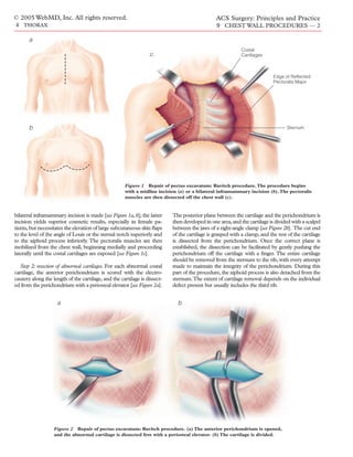 © 2005 WebMD, Inc. All rights reserved.                                                        ACS Surgery: Principles and Practice
4 THORAX                                                                                        9 CHEST WALL PROCEDURES — 2

       a
                                                                                                           Costal
                                                                 c                                         Cartilages



                                                                                                                           Edge of Reflected
                                                                                                                           Pectoralis Major




       b                                                                                                                         Sternum




                                                     Figure 1 Repair of pectus excavatum: Ravitch procedure. The procedure begins
                                                     with a midline incision (a) or a bilateral inframammary incision (b). The pectoralis
                                                     muscles are then dissected off the chest wall (c).


bilateral inframammary incision is made [see Figure 1a, b]; the latter     The posterior plane between the cartilage and the perichondrium is
incision yields superior cosmetic results, especially in female pa-        then developed in one area, and the cartilage is divided with a scalpel
tients, but necessitates the elevation of large subcutaneous skin ﬂaps     between the jaws of a right-angle clamp [see Figure 2b]. The cut end
to the level of the angle of Louis or the sternal notch superiorly and     of the cartilage is grasped with a clamp, and the rest of the cartilage
to the xiphoid process inferiorly. The pectoralis muscles are then         is dissected from the perichondrium. Once the correct plane is
mobilized from the chest wall, beginning medially and proceeding           established, the dissection can be facilitated by gently pushing the
laterally until the costal cartilages are exposed [see Figure 1c].         perichondrium off the cartilage with a ﬁnger. The entire cartilage
                                                                           should be removed from the sternum to the rib, with every attempt
  Step 2: resection of abnormal cartilages. For each abnormal costal       made to maintain the integrity of the perichondrium. During this
cartilage, the anterior perichondrium is scored with the electro-          part of the procedure, the xiphoid process is also detached from the
cautery along the length of the cartilage, and the cartilage is dissect-   sternum.The extent of cartilage removal depends on the individual
ed from the perichondrium with a periosteal elevator [see Figure 2a].      defect present but usually includes the third rib.


                    a                                                        b




                   Figure 2 Repair of pectus excavatum: Ravitch procedure. (a) The anterior perichondrium is opened,
                   and the abnormal cartilage is dissected free with a periosteal elevator. (b) The cartilage is divided.
 