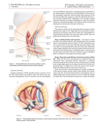 © 2005 WebMD, Inc. All rights reserved.                                                       ACS Surgery: Principles and Practice
4 THORAX                                                                                      9 CHEST WALL PROCEDURES — 5


                                                          Subclavian      via several different approaches, including posterior, supraclavicu-
                                                          Artery          lar, infraclavicular, transthoracic, and transaxillary. I focus here on
                                                                          the transaxillary approach, which provides good exposure of the
                                                                          ﬁrst rib and allows the surgeon to avoid the subclavian blood ves-
                                                                          sels and the brachial plexus. Regardless of the speciﬁc surgical
                                                                          approach followed, any surgeon embarking on a ﬁrst rib resection
                                                             Subclavian
                                                             Vein
                                                                          must have a detailed knowledge of the thoracic outlet to keep from
                                                                          injuring the neurovascular structures in the area.
Middle
Scalene
                                                                             Operative Technique
Muscle                                                                       The patient is placed in the lateral decubitus position, and the
                                                                          affected arm is kept at a 90° angle either by an arm holder or, alter-
                                                                          natively, by an assistant. Care must be taken not to hyperabduct or
                                                                          hyperextend the shoulder. The arm, the axilla, and the chest are
                                                               Brachial
                                                                          prepared and draped into the sterile ﬁeld.
 Posterior                                                     Plexus
 Scalene                                                                      Step 1: initial incision and exposure An incision is made
 Muscle
                                                                          just below the axillary hair line and extended from the pectoralis
                                                               Apex of    major to the latissimus dorsi [see Figure 7]. The subcutaneous tis-
                                                               Pleura
                                                                          sue is incised down to the chest wall with the electrocautery, with
                                                                          care taken to stay perpendicular to the axis of the chest. Dissection
                                                              1st Rib     is then begun along the chest wall and carried toward the ﬁrst rib.
Anterior                                                                  The intercostal brachial nerve is identiﬁed where it exits between
Scalene
Muscle                                                                    the ﬁrst and second ribs. This nerve should be spared: dividing it
                                                                          leads to numbness of the upper inner biceps region.
             Latissimus
             Dorsi Border                                                    Step 2: dissection and division of anterior portion of ﬁrst
                                                       Pectoralis Major   rib When the ﬁrst rib is encountered, it is dissected from the
                          Skin Incision                Border             periosteum with a periosteal elevator. Dissection is continued
                                                                          anteriorly along the rib until just past the subclavian vein, at which
 Figure 7 Transaxillary ﬁrst rib resection. Shown are the                 point a right-angle clamp can be passed around the rib in the sub-
 transaxillary incision and the thoracic outlet anatomy.                  periosteal plane. A Gigli saw or a ﬁrst rib cutter is then used to
                                                                          divide the anterior portion of the rib [see Figure 8a].
                                                                             Next, the ﬁrst rib is retracted inferiorly to permit visualization
   Operative Planning                                                     of the anterior scalene muscle, which is then divided at its attach-
  Surgical treatment of TOS typically involves resection of the           ment to the rib. To prevent thermal injury to the phrenic nerve, a
ﬁrst rib, which widens the thoracic outlet and relieves the neu-          scalpel rather than an electrocautery is used to divide the muscle
rovascular impingement. First rib resection can be accomplished           [see Figure 8b]. Care should also be taken not to injure the subcla-



               a                                                             b




              Posterior                                     Anterior           Posterior                                      Anterior

              Figure 8 Transaxillary ﬁrst rib resection. (a) The anterior portion of the ﬁrst rib is cut. (b) The anterior
              scalene muscle is then divided.
 