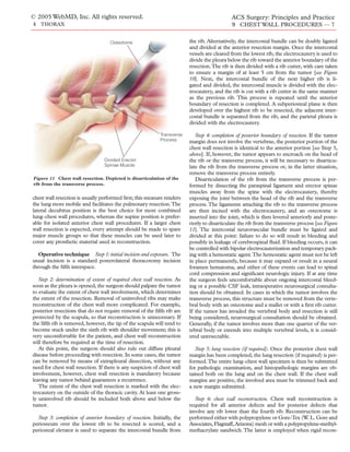 © 2005 WebMD, Inc. All rights reserved.                                                       ACS Surgery: Principles and Practice
4 THORAX                                                                                      9 CHEST WALL PROCEDURES — 7


                                     Osteotome                            the rib. Alternatively, the intercostal bundle can be doubly ligated
                                                                          and divided at the anterior resection margin. Once the intercostal
                                                                          vessels are cleared from the lowest rib, the electrocautery is used to
                                                                          divide the pleura below the rib toward the anterior boundary of the
                                                                          resection.The rib is then divided with a rib cutter, with care taken
                                                                          to ensure a margin of at least 5 cm from the tumor [see Figure
                                                                          10]. Next, the intercostal bundle of the next higher rib is li-
                                                                          gated and divided, the intercostal muscle is divided with the elec-
                                                                          trocautery, and the rib is cut with a rib cutter in the same manner
                                                                          as the previous rib. This process is repeated until the anterior
                                                                          boundary of resection is completed. A subperiosteal plane is then
                                                                          developed over the highest rib to be resected, the adjacent inter-
                                                                          costal bundle is separated from the rib, and the parietal pleura is
                                                                          divided with the electrocautery.

                                                             Transverse      Step 4: completion of posterior boundary of resection. If the tumor
                                                             Process      margin does not involve the vertebrae, the posterior portion of the
                                                                          chest wall resection is identical to the anterior portion [see Step 3,
                                                                          above]. If, however, the tumor appears to encroach on the head of
                                  Divided Erector                         the rib or the transverse process, it will be necessary to disarticu-
                                  Spinae Muscle                           late the rib from the transverse process or, in the latter situation,
                                                                          remove the transverse process entirely.
Figure 11 Chest wall resection. Depicted is disarticulation of the           Disarticulation of the rib from the transverse process is per-
rib from the transverse process.                                          formed by dissecting the paraspinal ligament and erector spinae
                                                                          muscles away from the spine with the electrocautery, thereby
chest wall resection is usually performed ﬁrst; this measure renders      exposing the joint between the head of the rib and the transverse
the lung more mobile and facilitates the pulmonary resection.The          process. The ligaments attaching the rib to the transverse process
lateral decubitus position is the best choice for most combined           are then incised with the electrocautery, and an osteotome is
lung–chest wall procedures, whereas the supine position is prefer-        inserted into the joint, which is then levered anteriorly and poste-
able for isolated anterior chest wall procedures. If a larger chest       riorly to disarticulate the rib from the transverse process [see Figure
wall resection is expected, every attempt should be made to spare         11]. The intercostal neurovascular bundle must be ligated and
major muscle groups so that these muscles can be used later to            divided at this point: failure to do so will result in bleeding and
cover any prosthetic material used in reconstruction.                     possibly in leakage of cerebrospinal ﬂuid. If bleeding occurs, it can
                                                                          be controlled with bipolar electrocauterization and temporary pack-
   Operative technique Step 1: initial incision and exposure. The         ing with a hemostatic agent.The hemostatic agent must not be left
usual incision is a standard posterolateral thoracotomy incision          in place permanently, because it may expand or result in a neural
through the ﬁfth interspace.                                              foramen hematoma, and either of these events can lead to spinal
                                                                          cord compression and signiﬁcant neurologic injury. If at any time
   Step 2: determination of extent of required chest wall resection. As   the surgeon feels uncomfortable about ongoing intercostal bleed-
soon as the pleura is opened, the surgeon should palpate the tumor        ing or a possible CSF leak, intraoperative neurosurgical consulta-
to evaluate the extent of chest wall involvement, which determines        tion should be obtained. In cases in which the tumor involves the
the extent of the resection. Removal of uninvolved ribs may make          transverse process, this structure must be removed from the verte-
reconstruction of the chest wall more complicated. For example,           bral body with an osteotome and a mallet or with a ﬁrst rib cutter.
posterior resections that do not require removal of the ﬁfth rib are      If the tumor has invaded the vertebral body and resection is still
protected by the scapula, so that reconstruction is unnecessary. If       being considered, neurosurgical consultation should be obtained.
the ﬁfth rib is removed, however, the tip of the scapula will tend to     Generally, if the tumor involves more than one quarter of the ver-
become stuck under the sixth rib with shoulder movement; this is          tebral body or extends into multiple vertebral levels, it is consid-
very uncomfortable for the patient, and chest wall reconstruction         ered unresectable.
will therefore be required at the time of resection.
   At this point, the surgeon should also rule out diffuse pleural           Step 5: lung resection (if required). Once the posterior chest wall
disease before proceeding with resection. In some cases, the tumor        margin has been completed, the lung resection (if required) is per-
can be removed by means of extrapleural dissection, without any           formed.The entire lung–chest wall specimen is then be submitted
need for chest wall resection. If there is any suspicion of chest wall    for pathologic examination, and histopathologic margins are ob-
involvement, however, chest wall resection is mandatory because           tained both on the lung and on the chest wall. If the chest wall
leaving any tumor behind guarantees a recurrence.                         margins are positive, the involved area must be trimmed back and
   The extent of the chest wall resection is marked with the elec-        a new margin submitted.
trocautery on the outside of the thoracic cavity. At least one gross-
ly uninvolved rib should be included both above and below the                Step 6: chest wall reconstruction. Chest wall reconstruction is
tumor.                                                                    required for all anterior defects and for posterior defects that
                                                                          involve any rib lower than the fourth rib. Reconstruction can be
  Step 3: completion of anterior boundary of resection. Initially, the    performed either with polypropylene or Gore-Tex (W. L. Gore and
periosteum over the lowest rib to be resected is scored, and a            Associates, Flagstaff,Arizona) mesh or with a polypropylene-methyl-
periosteal elevator is used to separate the intercostal bundle from       methacrylate sandwich. The latter is employed when rigid recon-
 