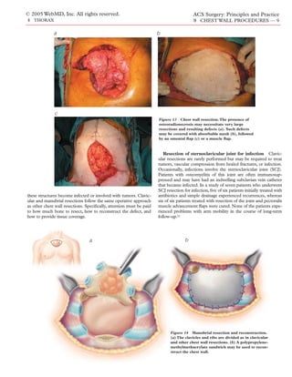 © 2005 WebMD, Inc. All rights reserved.                                                   ACS Surgery: Principles and Practice
4 THORAX                                                                                  9 CHEST WALL PROCEDURES — 9

              a                                                       b




              c
                                                                      Figure 13 Chest wall resection. The presence of
                                                                      osteoradionecrosis may necessitate very large
                                                                      resections and resulting defects (a). Such defects
                                                                      may be covered with absorbable mesh (b), followed
                                                                      by an omental ﬂap (c) or a muscle ﬂap.



                                                                         Resection of sternoclavicular joint for infection Clavic-
                                                                      ular resections are rarely performed but may be required to treat
                                                                      tumors, vascular compression from healed fractures, or infection.
                                                                      Occasionally, infections involve the sternoclavicular joint (SCJ).
                                                                      Patients with osteomyelitis of this joint are often immunosup-
                                                                      pressed and may have had an indwelling subclavian vein catheter
                                                                      that became infected. In a study of seven patients who underwent
                                                                      SCJ resection for infection, ﬁve of six patients initially treated with
these structures become infected or involved with tumors. Clavic-     antibiotics and simple drainage experienced recurrences, whereas
ular and manubrial resections follow the same operative approach      six of six patients treated with resection of the joint and pectoralis
as other chest wall resections. Speciﬁcally, attention must be paid   muscle advancement ﬂaps were cured. None of the patients expe-
to how much bone to resect, how to reconstruct the defect, and        rienced problems with arm mobility in the course of long-term
how to provide tissue coverage.                                       follow-up.21




                                 a                                                   b




                                                                             Figure 14 Manubrial resection and reconstruction.
                                                                             (a) The clavicles and ribs are divided as in clavicular
                                                                             and other chest wall resections. (b) A polypropylene-
                                                                             methylmethacrylate sandwich may be used to recon-
                                                                             struct the chest wall.
 