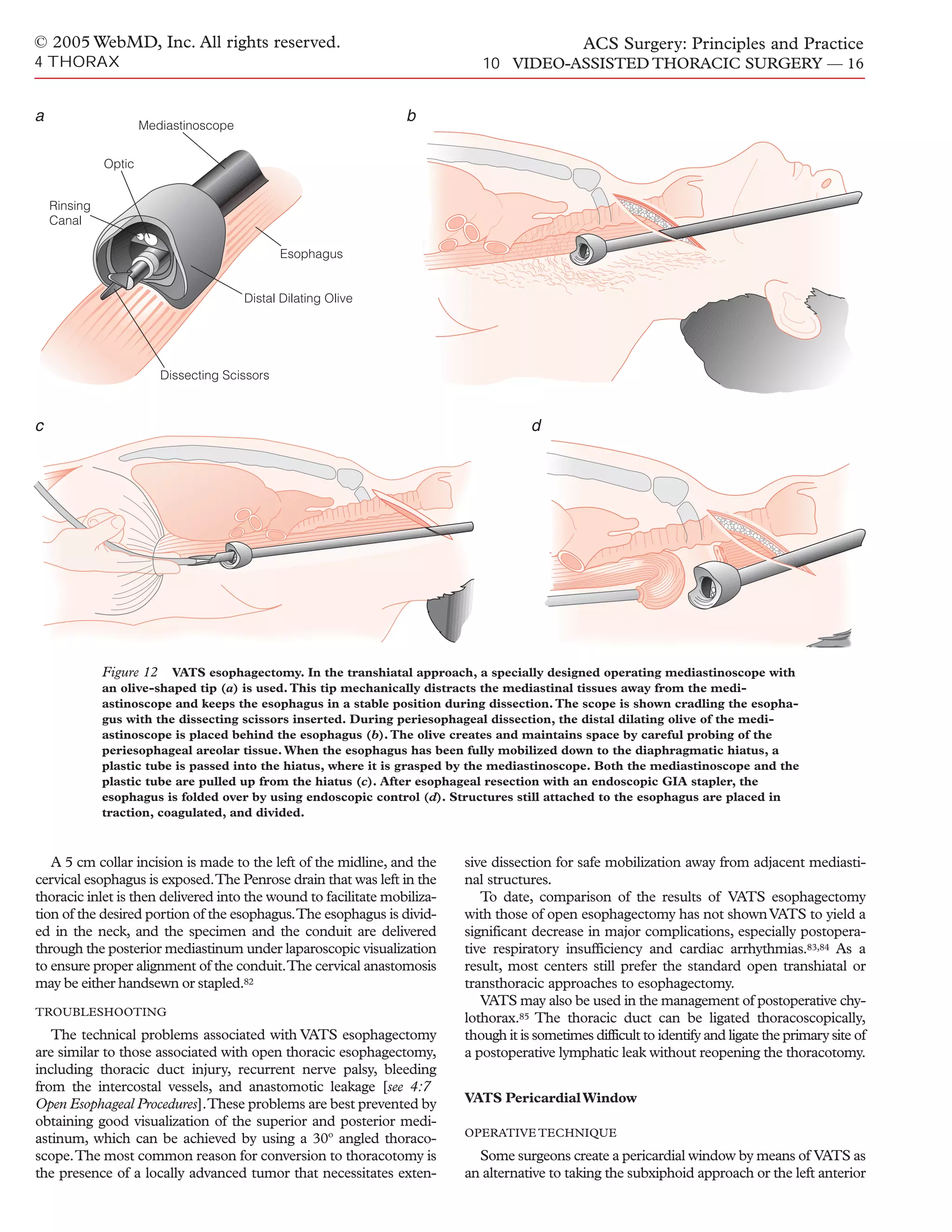 acs0410-video-assisted-thoracic-surgery-pdf