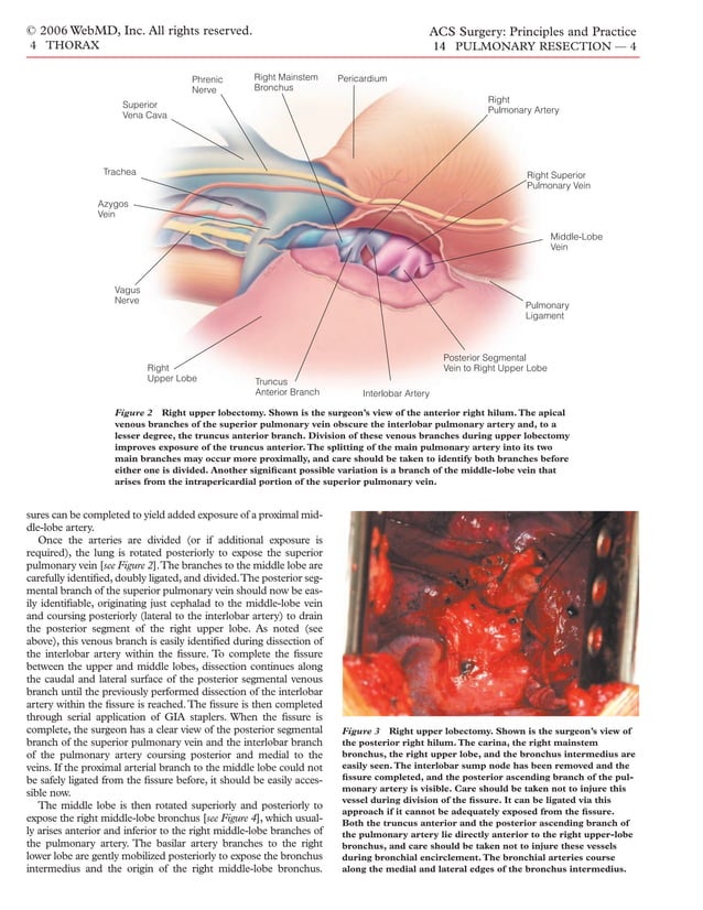 Lung Resection Instruments Acs0414 Pulmonary Resection | PDF