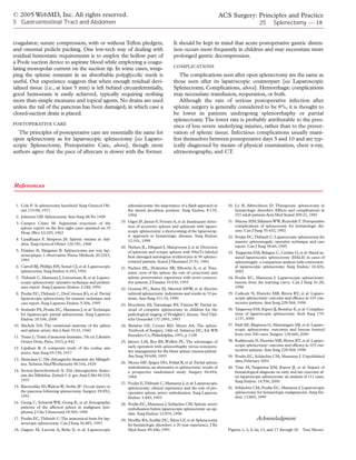 © 2005 WebMD, Inc. All rights reserved.                                                                                      ACS Surgery: Principles and Practice
5 Gastrointestinal Tract and Abdomen                                                                                                               25      Splenectomy — 18


coagulator; suture compression, with or without Teflon pledgets;                               It should be kept in mind that acute postoperative gastric disten-
and omental pedicle packing. One low-tech way of dealing with                                  tion occurs more frequently in children and may necessitate more
residual hemostatic requirements is to employ the hollow part of                               prolonged gastric decompression.
a Poole suction device to aspirate blood while employing a coagu-
                                                                                               COMPLICATIONS
lating monopolar current on the suction tip. In some cases, wrap-
ping the splenic remnant in an absorbable polyglycolic mesh is                                    The complications seen after open splenectomy are the same as
useful. Our experience suggests that when enough residual devi-                                those seen after its laparoscopic counterpart [see Laparoscopic
talized tissue (i.e., at least 5 mm) is left behind circumferentially,                         Splenectomy, Complications, above]. Hemorrhagic complications
good hemostasis is easily achieved, typically requiring nothing                                may necessitate transfusion, reoperation, or both.
more than simple measures and topical agents. No drains are used                                  Although the rate of serious postoperative infection after
unless the tail of the pancreas has been damaged, in which case a                              splenic surgery is generally considered to be 8%, it is thought to
closed-suction drain is placed.                                                                be lower in patients undergoing splenorrhaphy or partial
                                                                                               splenectomy. The lower rate is probably attributable to the pres-
POSTOPERATIVE CARE
                                                                                               ence of less severe underlying injuries, rather than to the preser-
  The principles of postoperative care are essentially the same for                            vation of splenic tissue. Infectious complications usually mani-
open splenectomy as for laparoscopic splenectomy [see Laparo-                                  fest themselves between postoperative days 5 and 10 and are typ-
scopic Splenectomy, Postoperative Care, above], though most                                    ically diagnosed by means of physical examination, chest x-ray,
authors agree that the pace of aftercare is slower with the former.                            ultrasonography, and CT.




References


 1. Cole F: Is splenectomy harmless? Surg Gynecol Ob-              adrenalectomy: the importance of a flank approach in         30. Ly B, Albrechtson D: Therapeutic splenectomy in
    stet 133:98, 1971                                              the lateral decubitus position. Surg Endosc 8:135,               hematologic disorders. Effects and complications in
 2. Johnston GB: Splenectomy. Ann Surg 48:50, 1908                 1994                                                             221 adult patients Acta Med Scand 209:21, 1981

 3. Campos Cristo M: Segmental resections of the               19. Gigot JF, Jamar F, Ferrant A, et al: Inadequate detec-       31. Macrae HM,Yakimets WW, Reynolds T: Perioperative
                                                                   tion of accessory spleens and splenosis with laparo-             complications of splenectomy for hematologic dis-
    spleen: report on the first eight cases operated on. O
                                                                   scopic splenectomy: a shortcoming of the laparoscop-             ease. Can J Surg 35:432, 1992
    Hosp (Rio) 62:205, 1962
                                                                   ic approach in hematologic diseases. Surg Endosc             32. Poulin EC,Thibault C: Laparoscopic splenectomy for
 4. Upadhyaya P, Simpson JS: Splenic trauma in chil-               12:101, 1998                                                     massive splenomegaly: operative technique and case
    dren. Surg Gynecol Obstet 126:781, 1968
                                                               20. Nielsen JL, Ellegard J, Marqversen J, et al: Detection           report. Can J Surg 38:69, 1995
 5. Delaitre B, Maignien B: Splénectomie par voie lap-             of splenosis and ectopic spleens with 99mTc-labeled          33. Targarona EM, Balague C, Cerdan G, et al: Hand-as-
    aroscopique, 1 observation. Presse Médicale 20:2263,           heat damaged autologous erythrocytes in 90 splenec-              sisted laparoscopic splenectomy (HALS) in cases of
    1991                                                           tomized patients. Scand J Haematol 27:51, 1981                   splenomegaly: a comparison analysis with convention-
 6. Carroll BJ, Phillips EH, Semel CJ, et al: Laparoscopic     21. Pachter HL, Hofstetter SR, Elkowitz A, et al: Trau-              al laparoscopic splenectomy. Surg Endosc 16:426,
    splenectomy. Surg Endosc 6:183, 1992                           matic cysts of the spleen: the role of cystectomy and            2002
 7. Thibault C, Mamazza J, Létourneau R, et al: Laparo-            splenic preservation: experience with seven consecu-         34. Poulin EC, Mamazza J: Laparoscopic splenectomy:
    scopic splenectomy: operative technique and prelimi-           tive patients. J Trauma 35:430, 1993                             lessons from the learning curve. Can J Surg 41:28,
    nary report. Surg Laparosc Endosc 2:248, 1992              22. Guzetta PC, Ruley EJ, Merrick HFW, et al: Elective               1998
 8. Poulin EC,Thibault C, DesCôteaux JG, et al: Partial            subtotal splenectomy: indications and results in 33 pa-      35. Cathode N, Hurwitz MB, Rivera RT, et al: Laparo-
    laparoscopic splenectomy for trauma: technique and             tients. Ann Surg 211:34, 1990                                    scopic splenectomy: outcome and efficacy in 103 con-
    case report. Surg Laparosc Endosc 5:306, 1995                                                                                   secutive patients. Ann Surg 228:568, 1998
                                                               23. Hoeckstra HJ, Tamminga RY, Timens W: Partial in-
 9. Seshadri PA, Poulin EC, Mamazza J, et al:Technique             stead of complete splenectomy in children for the            36. Targarona EM, Espert JJ, Bombuy E, et al: Complica-
    for laparoscopic partial splenectomy. Surg Laparosc            pathological staging of Hodgkin’s disease. Ned Tijd-             tions of laparoscopic splenectomy. Arch Surg 135:
    Endosc 10:106, 2000                                            schr Geneeskd 137:2491, 1993                                     1137, 2000
10. Michels NA: The variational anatomy of the spleen          24. Sheldon GF, Croom RD, Meyer AA: The spleen.                  37. Park AE, Birgisson G, Mastrangelo MJ, et al: Laparo-
    and splenic artery. Am J Anat 70:21, 1942                      Textbook of Surgery, 14th ed. Sabiston DC, Ed.WB                 scopic splenectomy: outcomes and lessons learned
                                                                   Saunders Co, Philadelphia, 1991, p 1108                          from over 200 cases. Surgery 128:660, 2000
11. Testut L:Traité d’anatomie humaine, 7th ed. Librairie
    Octave Doin, Paris, 1923, p 942                            25. Jalovec LM, Boe BS, Wyffels PL: The advantages of            38. Katkhouda N, Hurwitz MB, Rivera RT, et al: Laparo-
                                                                   early operation with splenorrhaphy versus nonopera-              scopic splenectomy: outcome and efficacy in 103 con-
12. Lipshutz B: A composite study of the coeliac axis                                                                               secutive patients. Ann Surg 228:568, 1998
    artery. Ann Surg 65:159, 1917                                  tive management for the blunt splenic trauma patient.
                                                                   Am Surg 59:698, 1993                                         39. Poulin EC, Schlachta CM, Mamazza J: Unpublished
13. Henschen C: Die chirurgische Anatomie der Milzgefi-                                                                             data, February 2001
    isse. Schweiz Med Wochenschr 58:164, 1928                  26. Mozes MF, Spigos DG, Pollak R, et al: Partial splenic
                                                                   embolization, an alternative to splenectomy: results of      40. Trias M, Targarona EM, Espert JJ, et al: Impact of
14. Ssoson-Jaroschewitsch A: Zür chirurgischen Anato-              a prospective randomized study. Surgery 96:694,                  hematological diagnosis on early and late outcome af-
    mie des Milzhilus. Zeitsch f. d. ges. Anat I Abt 84:218,       1984                                                             ter laparoscopic splenectomy: an analysis of 111 cases.
    1937                                                                                                                            Surg Endosc 14:556, 2000
                                                               27. Poulin E,Thibault C, Mamazza J, et al: Laparoscopic
15. Baronofsky ID,Walton W, Noble JF: Occult injury to             splenectomy: clinical experience and the role of pre-        41. Schlachta CM, Poulin EC, Mamazza J: Laparoscopic
    the pancreas following splenectomy. Surgery 29:852,            operative splenic artery embolization. Surg Laparosc             splenectomy for hematologic malignancies. Surg En-
    1951                                                           Endosc 3:445, 1993                                               dosc 13:865, 1999
16. Goerg C, Schwerk WB, Goerg K, et al: Sonographic           28. Poulin EC, Mamazza J, Schlachta CM: Splenic artery
    patterns of the affected spleen in malignant lym-              embolization before laparoscopic splenectomy: an up-
    phoma. J Clin Ultrasound 18:569, 1990                          date. Surg Endosc 12:870, 1998
17. Poulin EC,Thibault C:The anatomical basis for lap-         29. Hoeffer RA, Scullin DC, Silver LF, et al: Splenectomy                         Acknowledgment
    aroscopic splenectomy. Can J Surg 36:485, 1993                 for hematologic disorders: a 20 year experience. J Ky
18. Gagner M, Lacroix A, Bolte E, et al: Laparoscopic              Med Assoc 89:446, 1991                                       Figures 1, 3, 4, 6a, 13, and 17 through 20   Tom Moore.
 