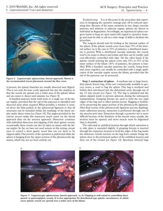 © 2005 WebMD, Inc. All rights reserved.                                                       ACS Surgery: Principles and Practice
5 Gastrointestinal Tract and Abdomen                                                                               25 Splenectomy — 8


                                                                            Troubleshooting. It is at this point in the procedure that experi-
                                                                         ence in designing the operative strategy pays off in reduced oper-
                                                                         ating time. Because of the many variations in size, shape, vascular
                                                                         patterns, and relations to adjacent organs, spleens are almost as
                                                                         individual as fingerprints. Accordingly, an experienced spleen sur-
                                            Rib Margin                   geon learns to keep an open mind with regard to operative strate-
                                                                         gy and must be able to call on a wide range of skills to facilitate the
                                                                         procedure.
                                                                            The surgeon should start by looking at the internal surface of
                                                                         the spleen. If the splenic vessels cover more than 75% of the inter-
                                                                         nal surface (as is the case in 70% of patients), a distributed anato-
                                                                         my is present. With a distributed vascular anatomy, the vessels
                                                                         tend to be easier to dissect and isolate and thus can be readily (and
                                                                         cost-effectively) controlled with clips. On the other hand, if the
                                                          Iliac Crest    splenic vessels entering the spleen cover only 25% to 35% of the
                                                                         inner surface of the hilum (30% of patients), the pattern is bun-
                                                                         dled. With a bundled vascular anatomy, the vessels, being fewer
                                                                         and closer together, can usually be controlled with a single appli-
                                                                         cation of the vascular stapler across the hilum, provided that the
                                                                         tail of the pancreas can be protected.
Figure 8 Laparoscopic splenectomy: lateral approach. Shown is
the recommended trocar placement around the iliac crest.                    Step 5: extraction of spleen A medium-size or large heavy-
                                                                         duty plastic freezer bag, of the sort commercially available in gro-
is present, the splenic branches are usually dissected and clipped.      cery stores, is used to bag the spleen. This bag is sterilized and
This is not only the least costly approach but also the simplest, in     folded, then introduced into the abdominal cavity through one of
that the vessels are spread over a wider area of the splenic hilum       the 12 mm trocars [see Figure 11]. The bag is unfolded and the
and are easier to dissect and separate [see Figure 9].                   spleen slipped inside to prevent splenosis during the subsequent
   A bundled anatomy lends itself more to a single use of the lin-       manipulations. Grasping forceps are used to hold the two rigid
ear stapler, provided that the tail of the pancreas is identified and    edges of the bag and to effect partial closure. Bagging is facilitat-
dissected away when required. When possible, a window is creat-          ed by preserving the upper portion of the phrenicocolic ligament.
ed above the hilar pedicle in the splenorenal ligament so that all       After final section of the phrenicocolic ligament and any diaphrag-
structures can be included within the markings of the linear sta-        matic adhesions present, extraction is performed through one of
pler under direct vision [see Figure 10].The angles provided by the      the anterior port sites. Extraction through a posterior site is more
various trocars make this maneuver much easier via the lateral           difficult because of the thickness of the muscle mass; usually, the
approach than via the anterior approach. Dissection continues            incision must be opened, and more muscle must be fulgurated
with individual dissection and clipping of the short gastric vessels;    than is desirable.
occasionally, these vessels can also be taken en masse with the lin-        The subcostal or umbilical incision through which extraction is
ear stapler. So far, we have not used sutures in this setting, except    to take place is extended slightly. A grasping forceps is inserted
once to control a short gastric vessel that was too short to be          through the extraction incision to hold the edges of the bag inside
clipped safely.This portion of the operation is performed while the      the abdomen. Gentle traction on the bag from outside brings the
spleen is hanging from the upper portion of the phrenicocolic lig-       spleen close to the peritoneal surface of the umbilical incision and
ament, which has not yet been entirely cut.                              then out of the wound [see Figure 12]. Specimen retrieval bags


              a                                                          b




              Figure 9 Laparoscopic splenectomy: lateral approach. (a, b) Clipping is well suited to controlling short
              gastric or gastroepiploic vessels. It is also appropriate for distributed-type splenic vasculatures, in which
              more splenic vessels are spread over a wider area of the hilum.
 