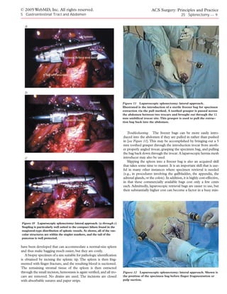 © 2005 WebMD, Inc. All rights reserved.                                                          ACS Surgery: Principles and Practice
5 Gastrointestinal Tract and Abdomen                                                                                   25 Splenectomy — 9


  a




  b

                                                                            Figure 11 Laparoscopic splenectomy: lateral approach.
                                                                            Illustrated is the introduction of a sterile freezer bag for specimen
                                                                            extraction via the pull method. A toothed grasper is passed across
                                                                            the abdomen between two trocars and brought out through the 12
                                                                            mm umbilical trocar site. This grasper is used to pull the extrac-
                                                                            tion bag back into the abdomen.


                                                                               Troubleshooting. The freezer bags can be more easily intro-
                                                                            duced into the abdomen if they are pulled in rather than pushed
                                                                            in [see Figure 11]. This may be accomplished by bringing out a 5
                                                                            mm toothed grasper through the introduction trocar from anoth-
                                                                            er properly angled trocar, grasping the specimen bag, and pulling
                                                                            the bag back down through the trocar. A laparoscopic hernia mesh
  c                                                                         introducer may also be used.
                                                                               Slipping the spleen into a freezer bag is also an acquired skill
                                                                            that takes some time to master. It is an important skill that is use-
                                                                            ful in many other instances where specimen retrieval is needed
                                                                            (e.g., in procedures involving the gallbladder, the appendix, the
                                                                            adrenal glands, or the colon). In addition, it is highly cost-effective,
                                                                            in that these commercially available bags cost only a few cents
                                                                            each. Admittedly, laparoscopic retrieval bags are easier to use, but
                                                                            their substantially higher cost can become a factor in a busy min-




Figure 10 Laparoscopic splenectomy: lateral approach. (a through c)
Stapling is particularly well suited to the compact hilum found in the
magistral-type distribution of splenic vessels. As shown, all of the vas-
cular structures are within the stapler markers, and the tail of the
pancreas is well protected.

have been developed that can accommodate a normal-size spleen
and thus make bagging much easier, but they are costly.
   A biopsy specimen of a size suitable for pathologic identification
is obtained by incising the splenic tip. The spleen is then frag-
mented with finger fracture, and the resulting blood is suctioned.
The remaining stromal tissue of the spleen is then extracted
through the small incision, hemostasis is again verified, and all tro-      Figure 12 Laparoscopic splenectomy: lateral approach. Shown is
cars are removed. No drains are used. The incisions are closed              the position of the specimen bag before finger fragmentation or
with absorbable sutures and paper strips.                                   pulp suction.
 