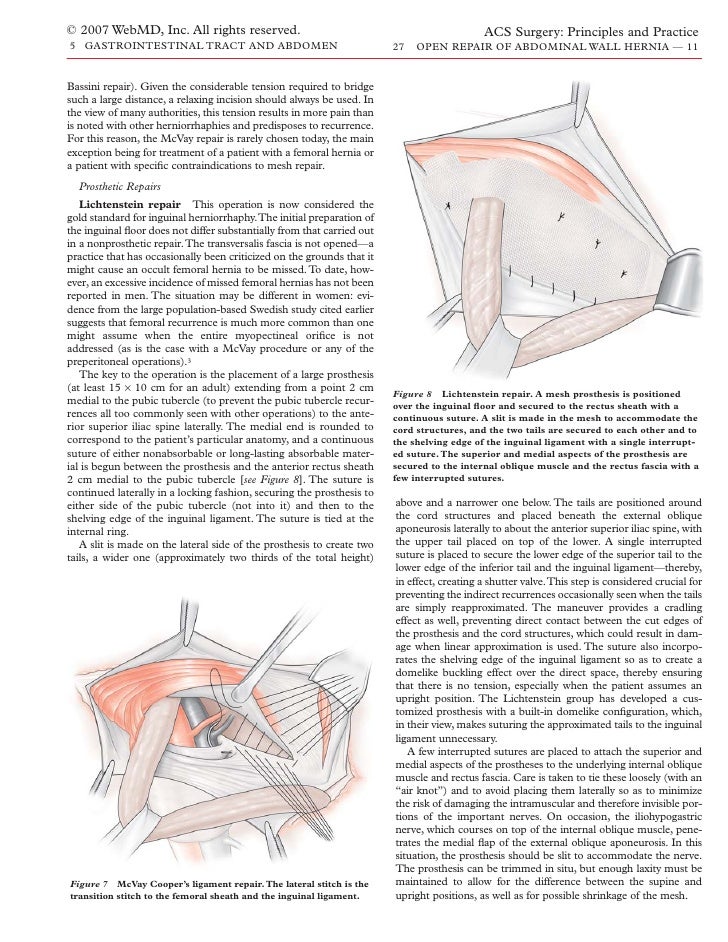 Acs0527 Open Repair Of Abdominal Wall Hernia 2007