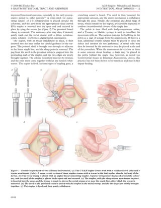 © 2008 BC Decker Inc                                                                         ACS Surgery: Principles and Practice
5 GASTROINTESTINAL TRACT AND ABDOMEN                                                    29 INTESTINAL ANASTOMOSIS — 12

improved functional outcome, especially in the early postop-          crunching sound is heard. The anvil is then loosened the
erative period in older patients.83 A whip-stitch (or purse-          appropriate amount, and the entire mechanism is withdrawn
string suture) of 2-0 polypropylene is placed around the              through the anus. Finally, the proximal and distal rings of
colotomy, and the anvil from the appropriately sized curved           tissue, which remain on the stapler, are carefully inspected to
EEA stapler is inserted into the open end and secured in              conﬁrm circumferential closure of the staple line.
place by tying the suture [see Figure 7].The proximal bowel              The pelvis is then ﬁlled with body-temperature saline,
clamp is removed. The assistant—who may also, if desired,             and a Toomey or bladder syringe is used to insufﬂate the
gently wash out the rectal stump with a dilute povidone-              neorectum with air. The surgeon watches for bubbling in the
iodine solution—performs a digital rectal examination.                pelvis as a sign of leakage from the anastomosis. If there is a
   The stapler, with its trocar attachment in place, is then          leak, additional soluble sutures must be placed to close the
inserted into the anus under the careful guidance of the sur-         defect and another air test performed. A rectal tube may
geon. The pointed shaft is brought out through or adjacent            then be inserted by the assistant or may be placed at the end
to the linear staple line, and the sharp point is removed. The        of the procedure. When the anastomosis is very low or there
peg from the anvil in the proximal colon is snapped into the          is some concern about healing, a drain may be placed in
protruding shaft of the stapler, and the two edges are slowly         the pelvis behind the staple line; however, as noted [see
brought together. The colonic mesentery must not be twisted,          Controversial Issues in Intestinal Anastomosis, above], this
and the ends must come together without any tension what-             practice has not been shown to be beneﬁcial and may in fact
soever. The stapler is ﬁred. In some types of stapling guns, a        impair healing.

a                             b                                                         c




            d                                                     e




Figure 7 Double-stapled end-to-end coloanal anastomosis. (a) The C-EEA stapler comes with both a standard anvil (left) and a
trocar attachment (right). A more recent version of these staplers comes with a trocar in the body rather than in the head of the
device. (b) The rectal stump is closed with an angled linear noncutting stapler. A purse-string suture is placed around the coloto-
my, and the anvil of the stapler is placed in the open end and secured. (c) The stapler, with the sharp trocar attachment in place,
is inserted into the anus, and the trocar is made to pierce the rectal stump at or near the staple line, after which the trocar is
removed. (d) The anvil in the proximal colon is joined with the stapler in the rectal stump, and the two edges are slowly brought
together. (e) The stapler is ﬁred and then gently withdrawn.




09/08
 