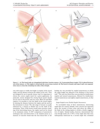 © 2008 BC Decker Inc                                                                         ACS Surgery: Principles and Practice
5 GASTROINTESTINAL TRACT AND ABDOMEN                                                     29 INTESTINAL ANASTOMOSIS — 5


 a                                                                     b




  c                                                                     d




Figure 4 (a) The bowel ends are triangulated with three traction sutures. (b) A noncutting linear stapler (TA) is placed between
two of the sutures. (c) The stapler is closed and the excess tissue excised. (d) The bowel is rotated, and steps b and c are repeated
twice more to close the remaining two sides of the triangle.


vary with respect to width, the height (or depth) of the closed      healing site was provided by stapled anastomoses in which
staple, and the distance between the staples in the rows. They       the staple height was adjusted to the thickness of the bowel
are designed for use in speciﬁc tissues, and it is important to      wall.33 The next best blood ﬂow was provided by double-layer
choose the correct stapler insert for a given application. In        stapled and sutured anastomoses, followed by double-layer
particular, inserts designed for closing blood vessels should        sutured anastomoses and tightly stapled anastomoses, in that
not be used on the bowel, and vice versa. With TA and EEA            order.
staplers, it is possible to vary the depth of the closed staples
by altering the distance between the staples and the anvil as          Single-Stapled versus Double-Stapled Anastomoses
the instrument is closed. The safe range of closure is usually          To accomplish many of these anastomoses, intersecting
indicated by a colored or shaded area on the shaft of the            staple lines are created. Initially, some concern was expressed
instrument. Thus, if full closure would cause excessive crush-       about the security of these areas and about the ability of
ing of the intervening tissues, the stapler need not be closed       the blade in the cutting staplers to divide a double staggered
to its maximum extent. A 1987 comparison of anastomotic              row of staples. Animal studies, however, demonstrated that
techniques that used blood ﬂow to the divided tissues as a           even though nearly all (> 90%) of the staple lines that were
measure of outcome found that the best blood ﬂow to the              subsequently transected by a second staple line contained



                                                                                                                                09/08
 
