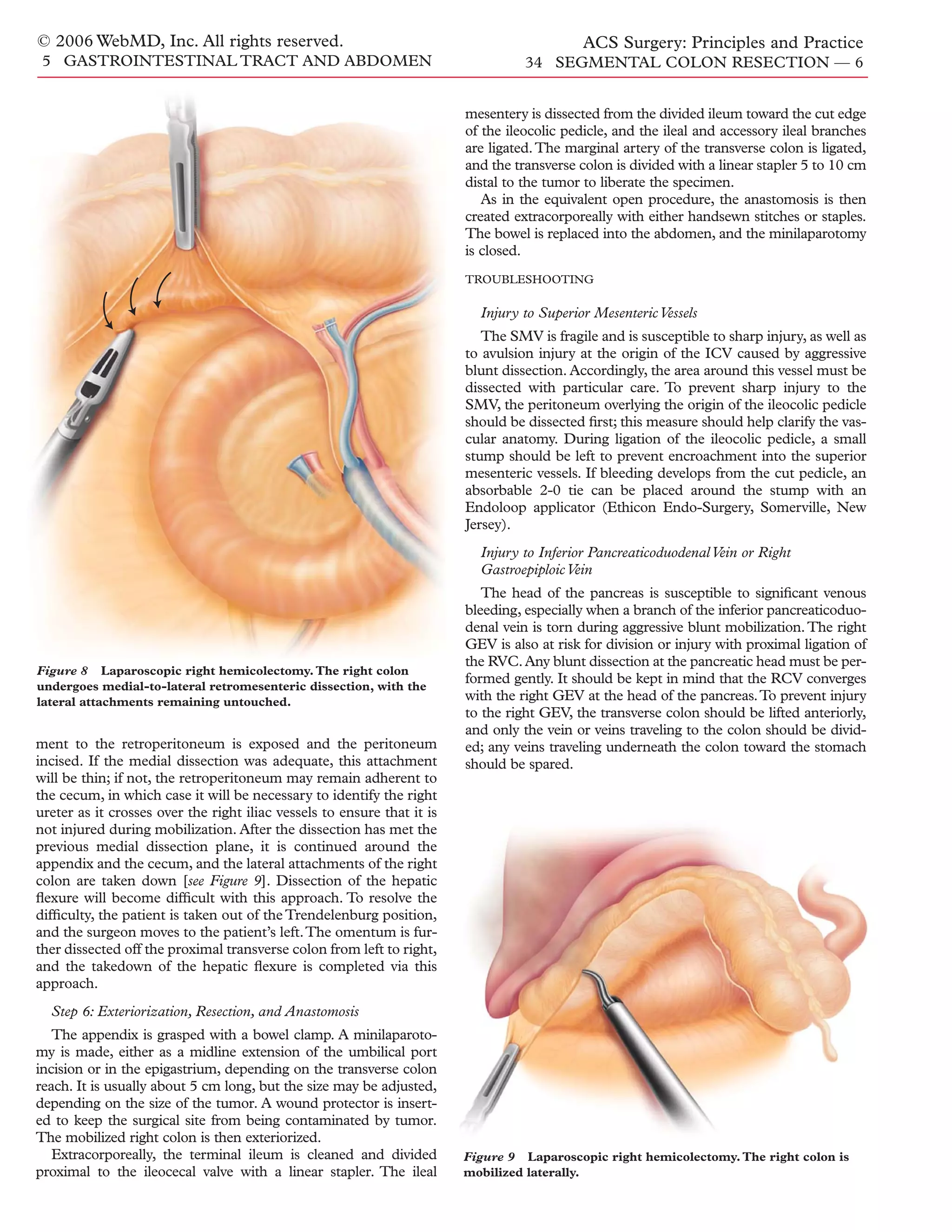 Acs0534 Segmental Colon Resection 2006 | PDF