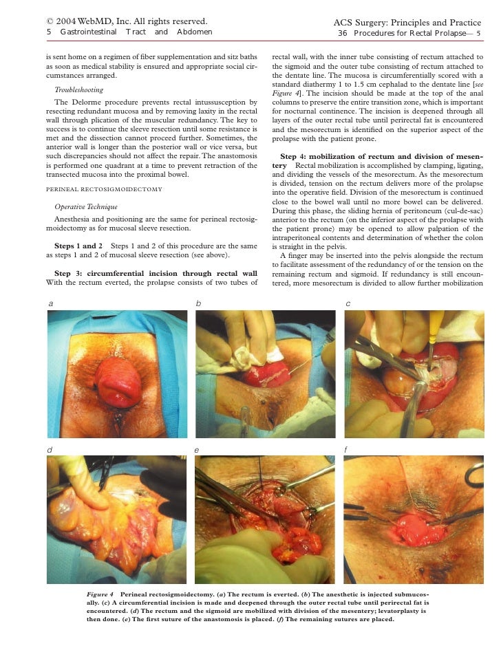 Acs0536 Procedures For Rectal Prolapse 2004