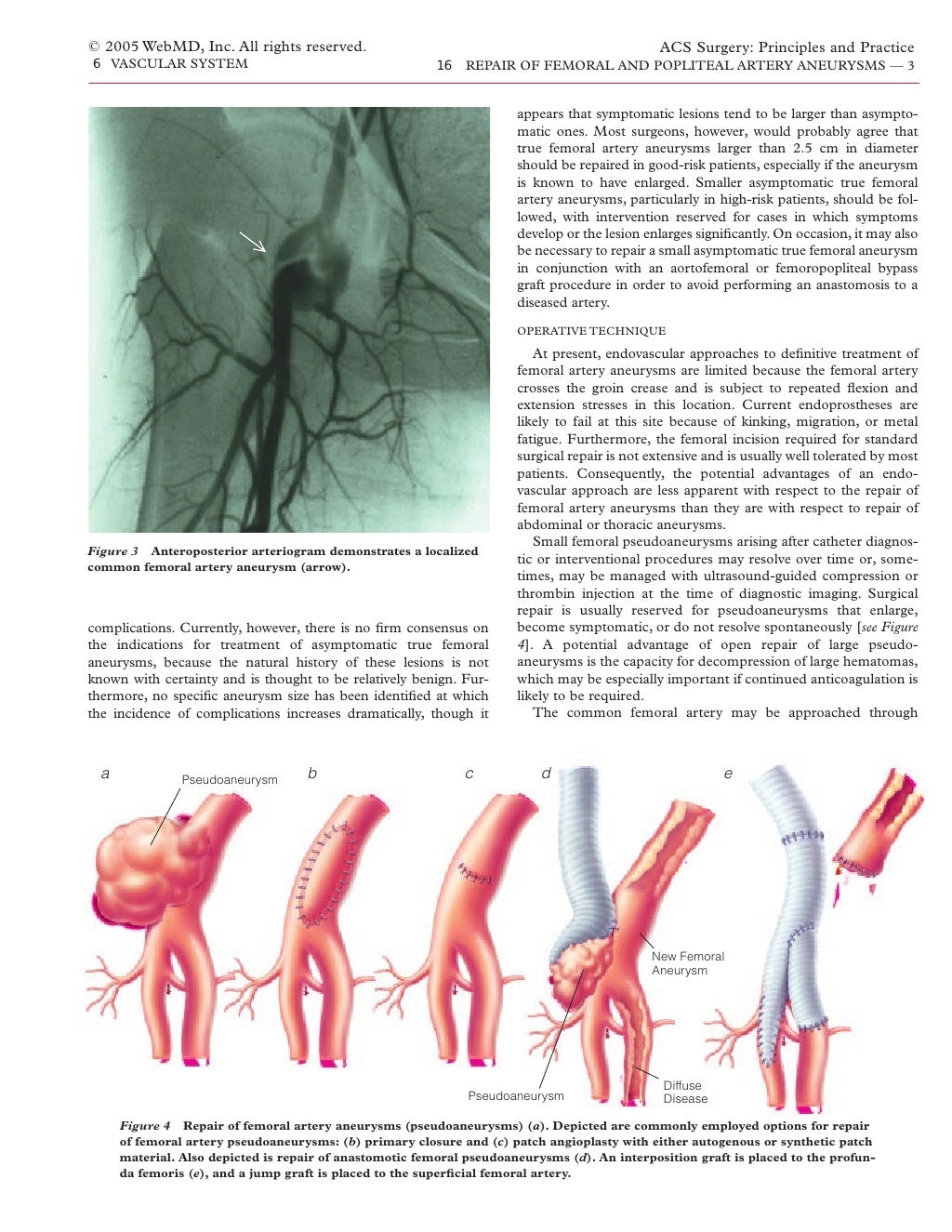 Acs0616 Repair Of Femoral And Popliteal Artery Aneurysms