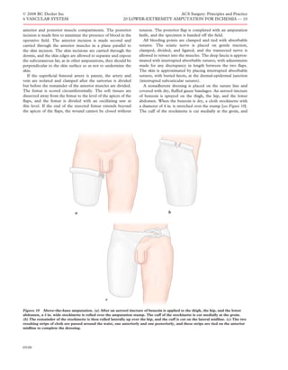 © 2008 BC Decker Inc                                                             ACS Surgery: Principles and Practice
6 VASCULAR SYSTEM                                           20 LOWER-EXTREMITY AMPUTATION FOR ISCHEMIA — 10

anterior and posterior muscle compartments. The posterior            tension. The posterior ﬂap is completed with an amputation
incision is made ﬁrst to minimize the presence of blood in the       knife, and the specimen is handed off the ﬁeld.
operative ﬁeld. The anterior incision is made second and                All bleeding points are clamped and tied with absorbable
carried through the anterior muscles in a plane parallel to          sutures. The sciatic nerve is placed on gentle traction,
the skin incision. The skin incisions are carried through the        clamped, divided, and ligated, and the transected nerve is
dermis, and the skin edges are allowed to separate and expose        allowed to retract into the muscles. The deep fascia is approx-
the subcutaneous fat; as in other amputations, they should be        imated with interrupted absorbable sutures, with adjustments
perpendicular to the skin surface so as not to undermine the         made for any discrepancy in length between the two ﬂaps.
skin.                                                                The skin is approximated by placing interrupted absorbable
  If the superﬁcial femoral artery is patent, the artery and         sutures, with buried knots, at the dermal-epidermal junction
vein are isolated and clamped after the sartorius is divided         (interrupted subcuticular sutures).
but before the remainder of the anterior muscles are divided.           A nonadherent dressing is placed on the suture line and
The femur is scored circumferentially. The soft tissues are          covered with dry, ﬂuffed gauze bandages. An aerosol tincture
dissected away from the femur to the level of the apices of the      of benzoin is sprayed on the thigh, the hip, and the lower
ﬂaps, and the femur is divided with an oscillating saw at            abdomen. When the benzoin is dry, a cloth stockinette with
this level. If the end of the resected femur extends beyond          a diameter of 4 in. is stretched over the stump [see Figure 10].
the apices of the ﬂaps, the wound cannot be closed without           The cuff of the stockinette is cut medially at the groin, and




                               a                                                       b




                                                 c

Figure 10 Above-the-knee amputation. (a) After an aerosol tincture of benzoin is applied to the thigh, the hip, and the lower
abdomen, a 4 in. wide stockinette is rolled over the amputation stump. The cuff of the stockinette is cut medially at the groin.
(b) The remainder of the stockinette is then rolled laterally up over the hip, and the cuff is cut on the lateral midline. (c) The two
resulting strips of cloth are passed around the waist, one anteriorly and one posteriorly, and these strips are tied on the anterior
midline to complete the dressing.




05/08
 