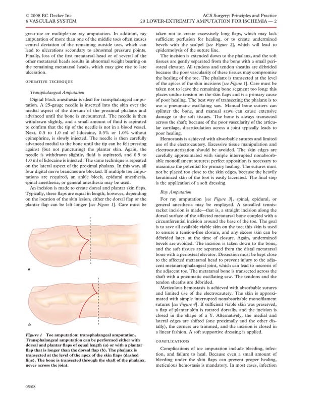 Acs0620 Lower Extremity Amputation For Ischemia | PDF