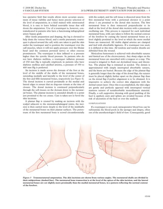 © 2008 BC Decker Inc                                                              ACS Surgery: Principles and Practice
6 VASCULAR SYSTEM                                            20 LOWER-EXTREMITY AMPUTATION FOR ISCHEMIA — 5

less operative ﬁeld that results allows more accurate assess-        with the scalpel, and the soft tissue is dissected away from the
ment of tissue viability and hence more precise selection of         ﬁrst metatarsal bone with a periosteal elevator to a point
the level of amputation; in a ﬁeld stained with extravasated         about 1 cm proximal to the dorsal skin incision. The ﬁrst
blood, it is easy to leave behind nonviable tissue that will         metatarsal bone is then transected perpendicular to its
doom the amputation. Use of a tourniquet is, however, con-           shaft at the level of the dorsal skin incision with a pneumatic
traindicated in patients who have a functioning infrapopliteal       oscillating saw. This process is repeated for each individual
artery bypass graft.                                                 metatarsal bone, with care taken to follow the normal contour
   After sterile preparation and draping, the leg is elevated to     of the forefoot by cutting the lateral metatarsal bones at a
help drain the venous blood, and a sterile pneumatic tourni-         level slightly proximal to the level at which the more medial
quet is placed around the calf, with care taken to pad the skin      bones are transected. All visible digital arteries are clamped
under the tourniquet and to position the tourniquet over the         and tied with absorbable ligatures. If a tourniquet was used,
calf muscles, where it will not apply pressure over the ﬁbular       it is deﬂated at this time. All tendons and tendon sheaths are
head (and the common peroneal nerve) or other osseous                débrided from the wound.
prominences. The tourniquet is then inﬂated to a pressure               Meticulous hemostasis is achieved with absorbable sutures
higher than the systolic blood pressure. In patients who do          and limited use of the electrocautery. Any sharp edges on the
not have diabetes mellitus, a tourniquet inﬂation pressure           metatarsal bones are smoothed with a rongeur or a rasp. The
of 250 mm Hg is typically employed; in patients who have             wound is irrigated to ﬂush out devitalized tissue and throm-
diabetes mellitus and calciﬁed arteries, a pressure of 350 to        bus. The plantar ﬂap is trimmed as needed. The dermis is
400 mm Hg is preferred.                                              approximated with simple interrupted absorbable sutures,
   An incision is made across the dorsum of the foot at the          and the knots are buried. Because the edge of the plantar ﬂap
level of the middle of the shafts of the metatarsal bones,           is generally longer than the edge of the dorsal ﬂap, the sutures
extending medially and laterally to the level of the center of       must be placed slightly farther apart on the plantar ﬂap than
the ﬁrst and ﬁfth metatarsal bones, respectively [see Figure 5].     on the dorsal ﬂap if perfect alignment is to be obtained. It is
The dorsal incision is curved proximally at the medial and           imperative to achieve the correct skin alignment with the
lateral edges to ensure that no dog-ears remain at the time of       dermal suture layer. Once this is accomplished, the skin edges
closure. The dorsal incision is continued perpendicularly            are gently and perfectly apposed with interrupted vertical
through the soft tissues on the dorsum down to the metatar-          mattress sutures of nonabsorbable monoﬁlament material.
sal bones. The plantar incision is extended distally to a point      Finally, a soft supportive dressing with good padding of the
just proximal to the toe crease. Care is taken not to bevel the      heel is applied; casts and splints are avoided because of the
skin incisions.                                                      risk of ulceration of the heel or over the malleoli.
   A plantar ﬂap is created by making an incision with the
scalpel adjacent to the metatarsophalangeal joints; the inci-        
sion is then carried more deeply to the level of the midshafts         If a tourniquet is not used, intraoperative blood loss can be
of the metatarsal bones on their plantar surfaces. The perios-       substantial; the blood pools in the sponges and drapes, often
teum of the ﬁrst metatarsal bone is scored circumferentially         out of the anesthesiologist’s ﬁeld of view. Consequently, good




Figure 5 Transmetatarsal amputation. The skin incisions are shown from various angles. The metatarsal shafts are divided in
their midportions (dashed line). The metatarsal bone transection is at the level of the apices of the skin incision, and the lateral
metatarsal bones are cut slightly more proximally than the medial metatarsal bones, in a pattern reﬂecting the normal contour
of the forefoot.




                                                                                                                                05/08
 