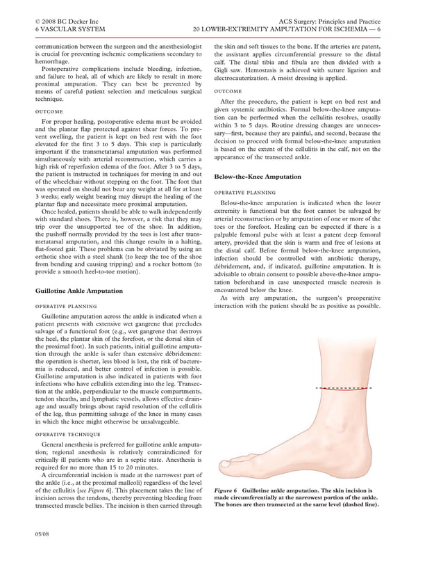 Acs0620 Lower Extremity Amputation For Ischemia | PDF
