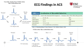 Esc Acs Algorithm 2023 ESC Guidelines for the management of ACS | PPTX