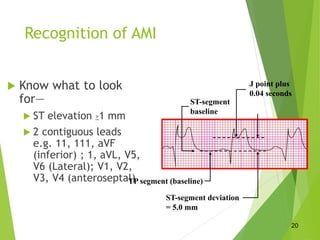 Recognition of AMI
 Know what to look
for—
 ST elevation >1 mm
 2 contiguous leads
e.g. 11, 111, aVF
(inferior) ; 1, aVL, V5,
V6 (Lateral); V1, V2,
V3, V4 (anteroseptal)
TP segment (baseline)
ST-segment deviation
= 5.0 mm
J point plus
0.04 seconds
ST-segment
baseline
20
 