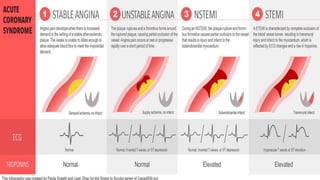 Pvc And Stemi ACS and STEMI.pptx