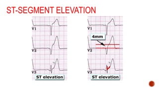 ST-SEGMENT ELEVATION
 