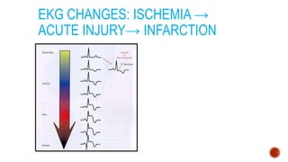 EKG CHANGES: ISCHEMIA →
ACUTE INJURY→ INFARCTION
 