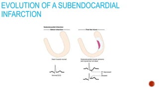 EVOLUTION OF A SUBENDOCARDIAL
INFARCTION
 