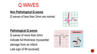 Q WAVES
Non Pathological Q waves
Q waves of less than 2mm are normal
Pathological Q waves
Q waves of more than 2mm
indicate full thickness myocardial
damage from an infarct
Late sign of MI (evolved)
 