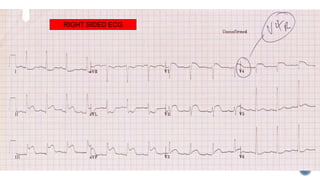 RIGHT SIDED ECG
 