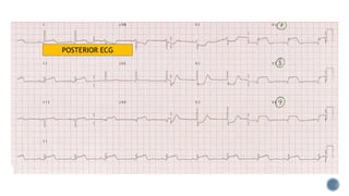 POSTERIOR ECG
 