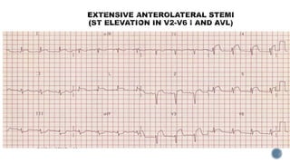 Acs ecg