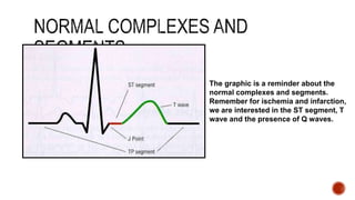 The graphic is a reminder about the
normal complexes and segments.
Remember for ischemia and infarction,
we are interested in the ST segment, T
wave and the presence of Q waves.
 