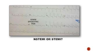 50/M/M
EPIGESTRIC
PAIN
 