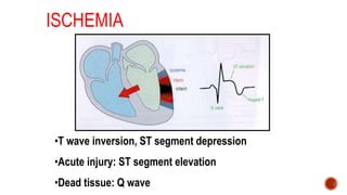ISCHEMIA
•T wave inversion, ST segment depression
•Acute injury: ST segment elevation
•Dead tissue: Q wave
 