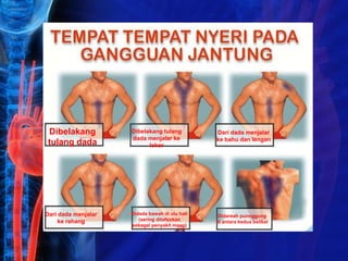 Dibelakang
tulang dada
Dibelakang tulang
dada menjalar ke
leher
Dari dada menjalar
ke bahu dan lengan
Dari dada menjalar
ke rahang
Didada bawah di ulu hati
(sering ditafsirkan
sebagai penyakit maag)
Didareah punnggung
di antara kedua belikat
 
